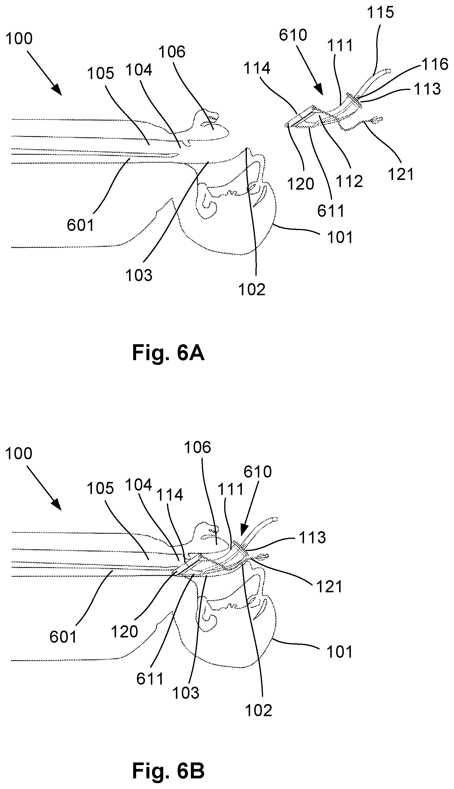 Patent US12564693 Figure 12 – Laryngeal mask airway intubation guide and method