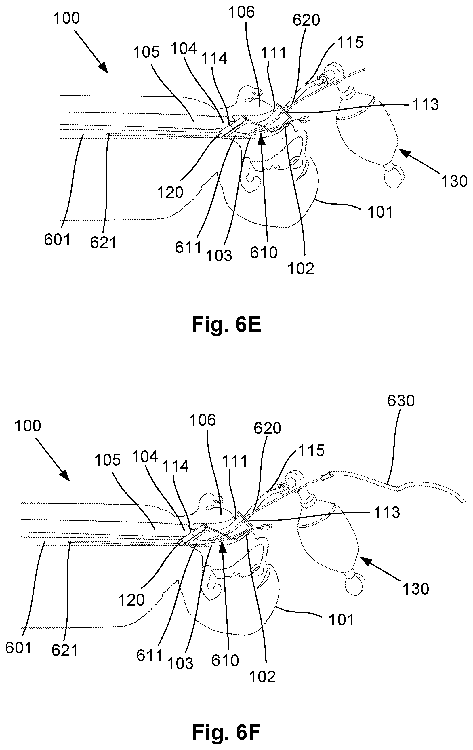 Patent US12564693 Figure 14 – Laryngeal mask airway intubation guide and method