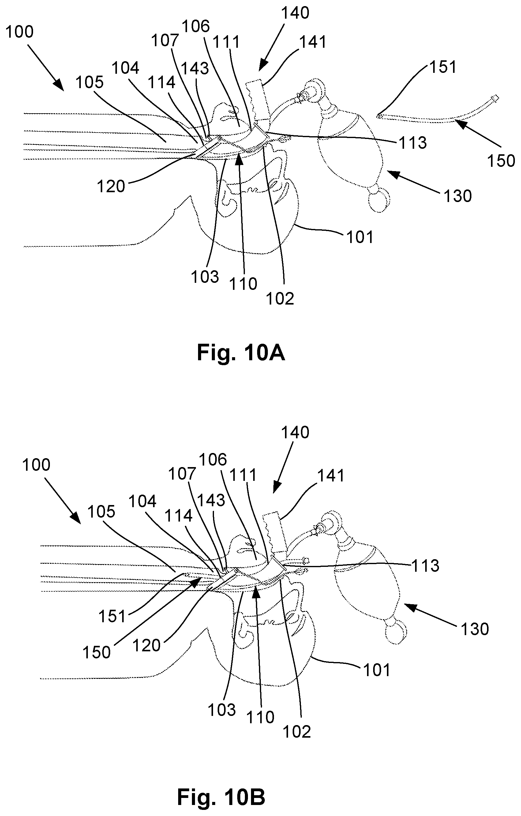Patent US12564693 Figure 17 – Laryngeal mask airway intubation guide and method