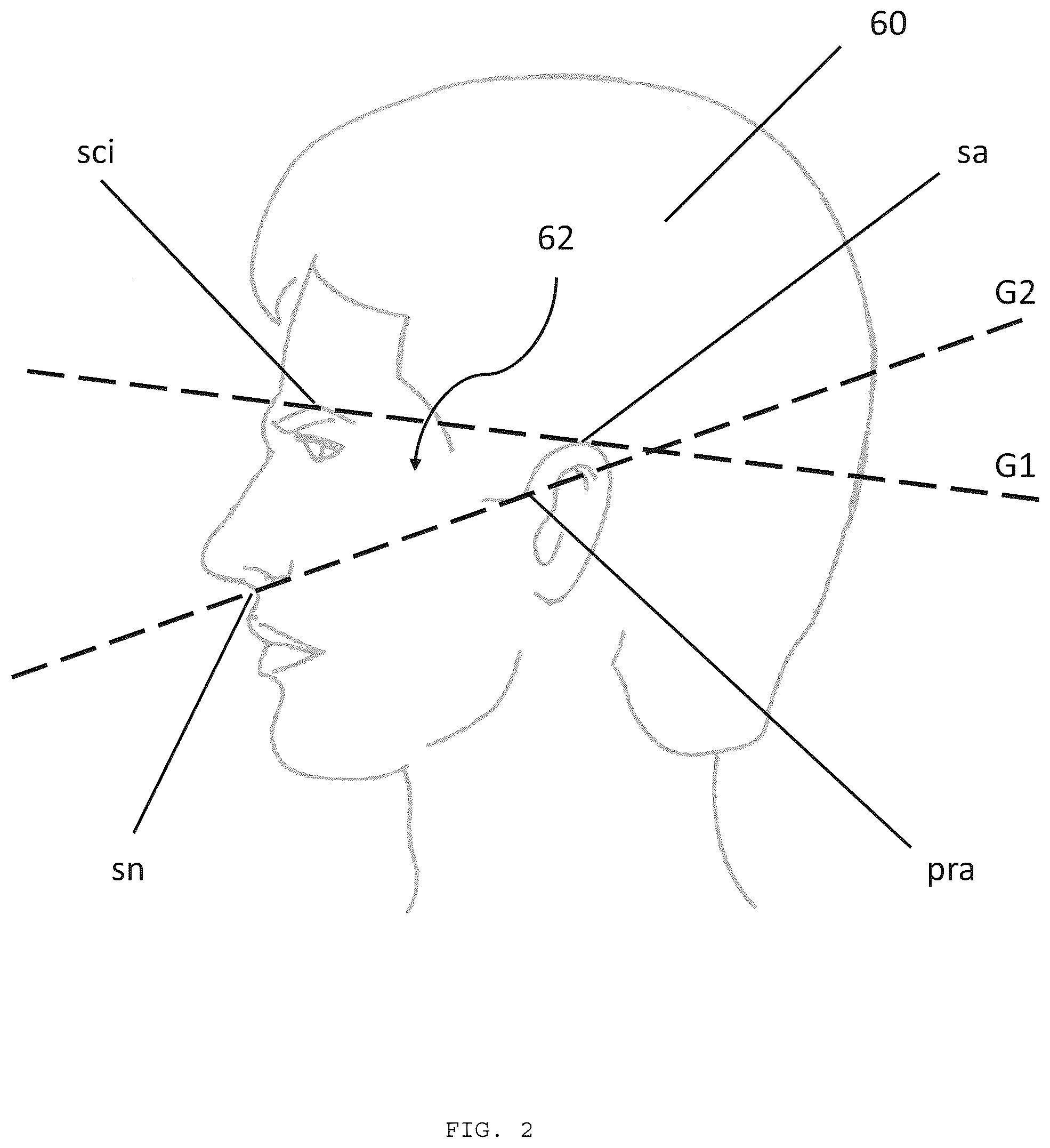 Patent US12564696 Figure 2 – Harness with eyeglass region