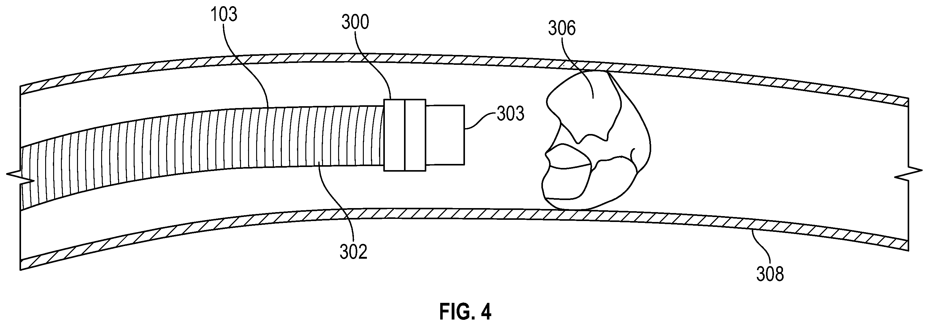 Patent US12564701 Figure 4 – Tube having an interior lubricious coating and systems and methods of applying the same