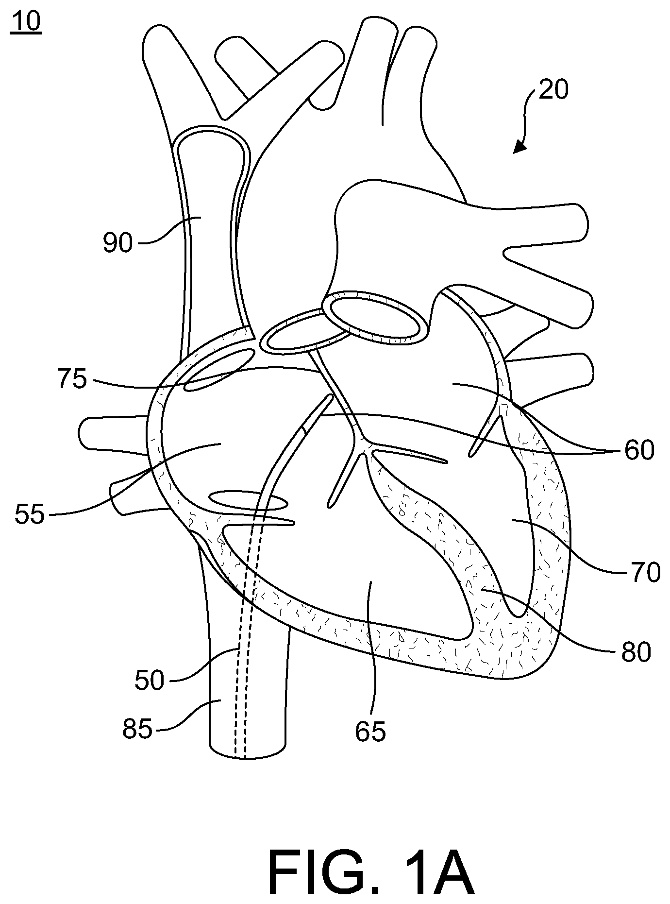 Patent US12564706 Figure 1 – Enhanced dilator and methods of using the same