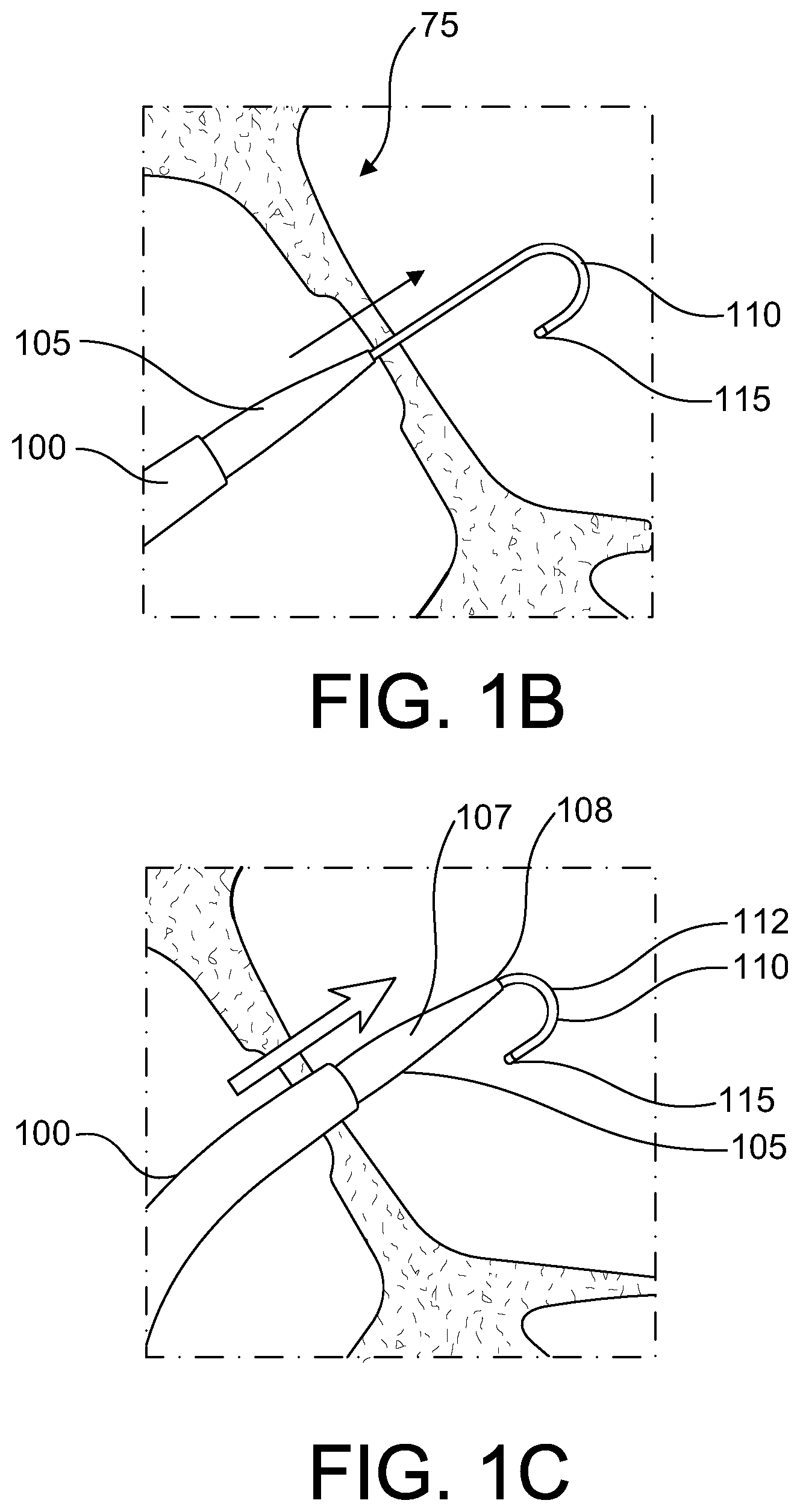 Patent US12564706 Figure 2 – Enhanced dilator and methods of using the same
