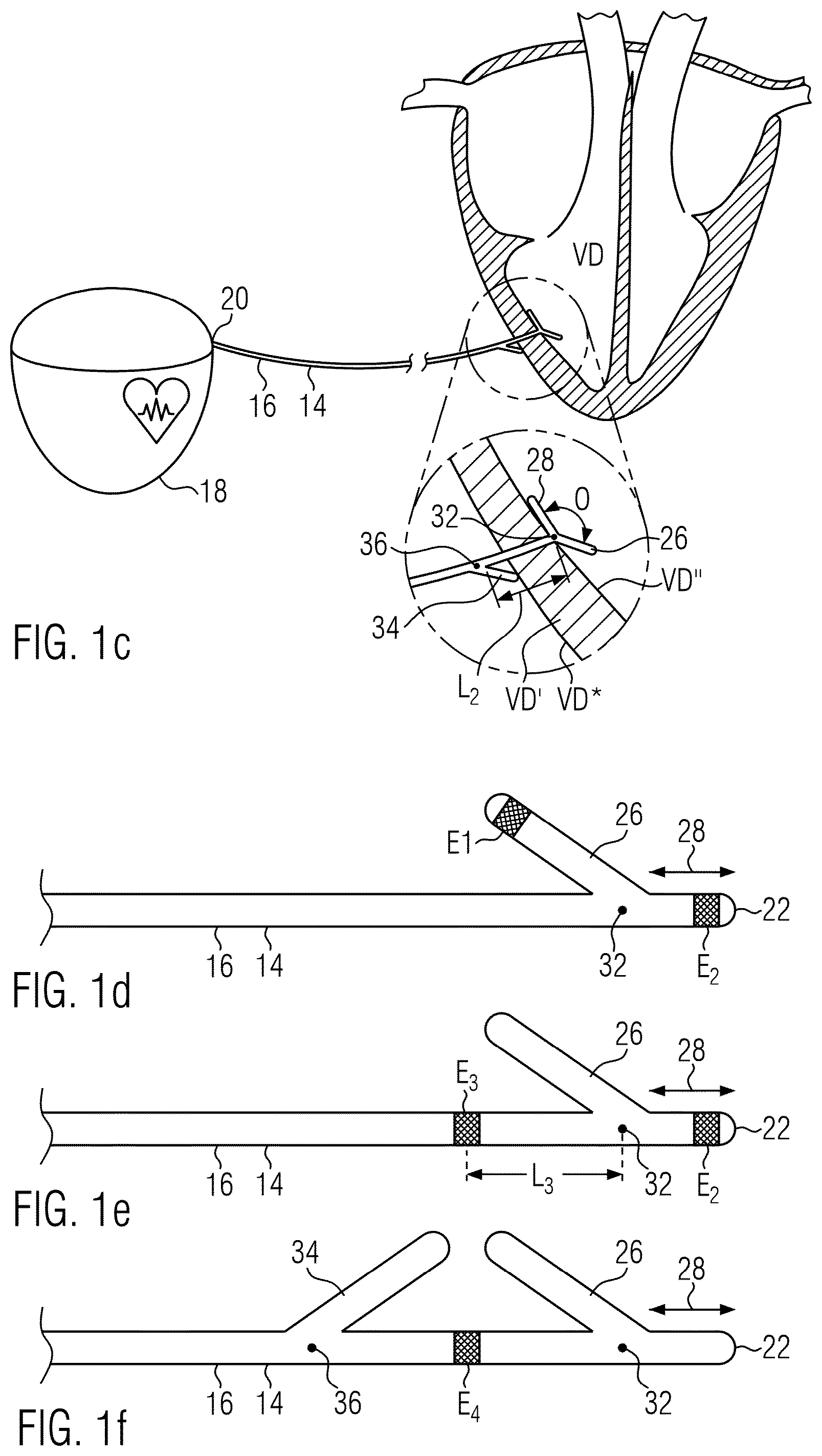 Patent US12564713 Figure 2 – Assembly of an implanting accessory and a flexible implantable stimulation lead