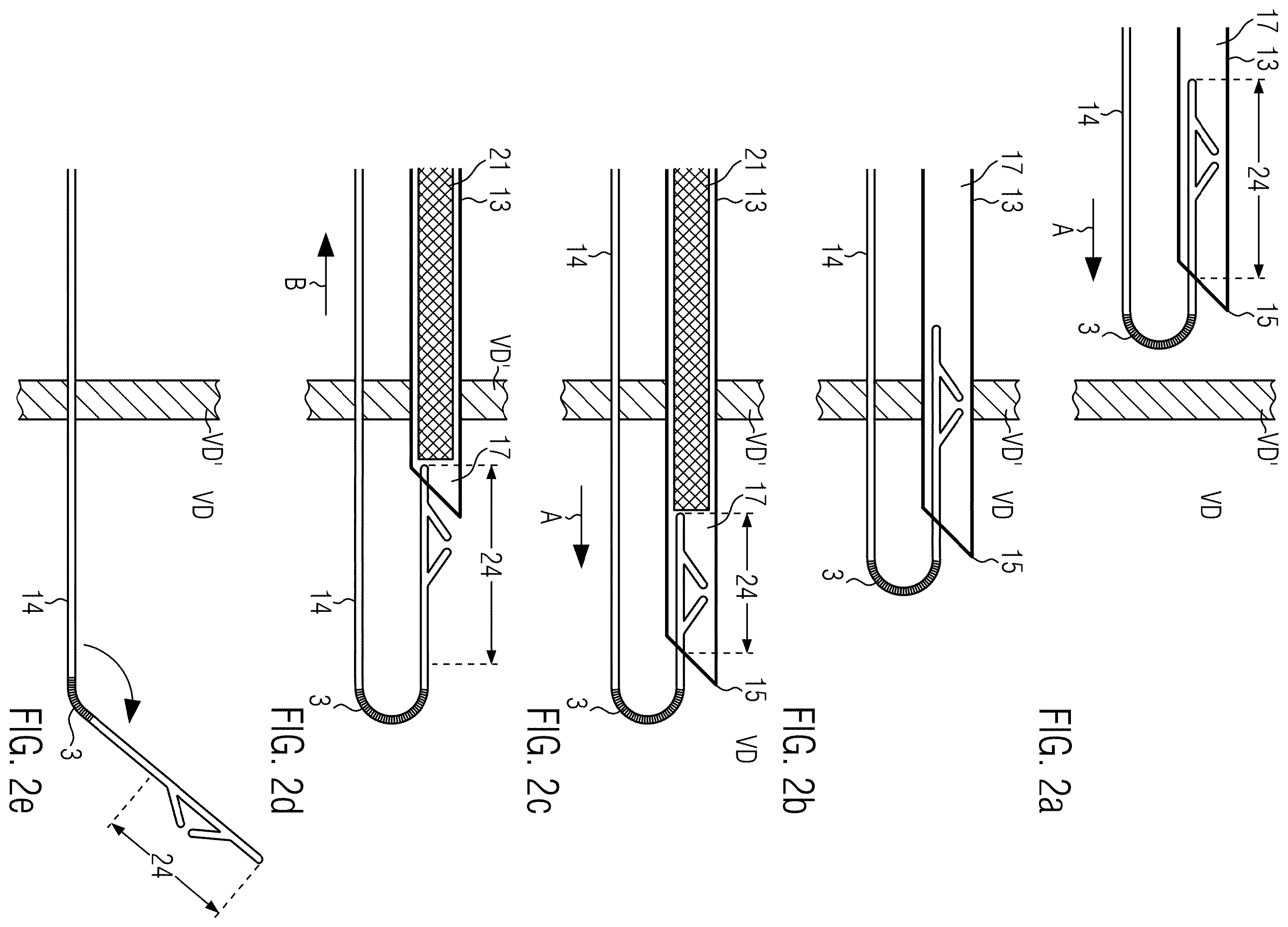Patent US12564713 Figure 3 – Assembly of an implanting accessory and a flexible implantable stimulation lead