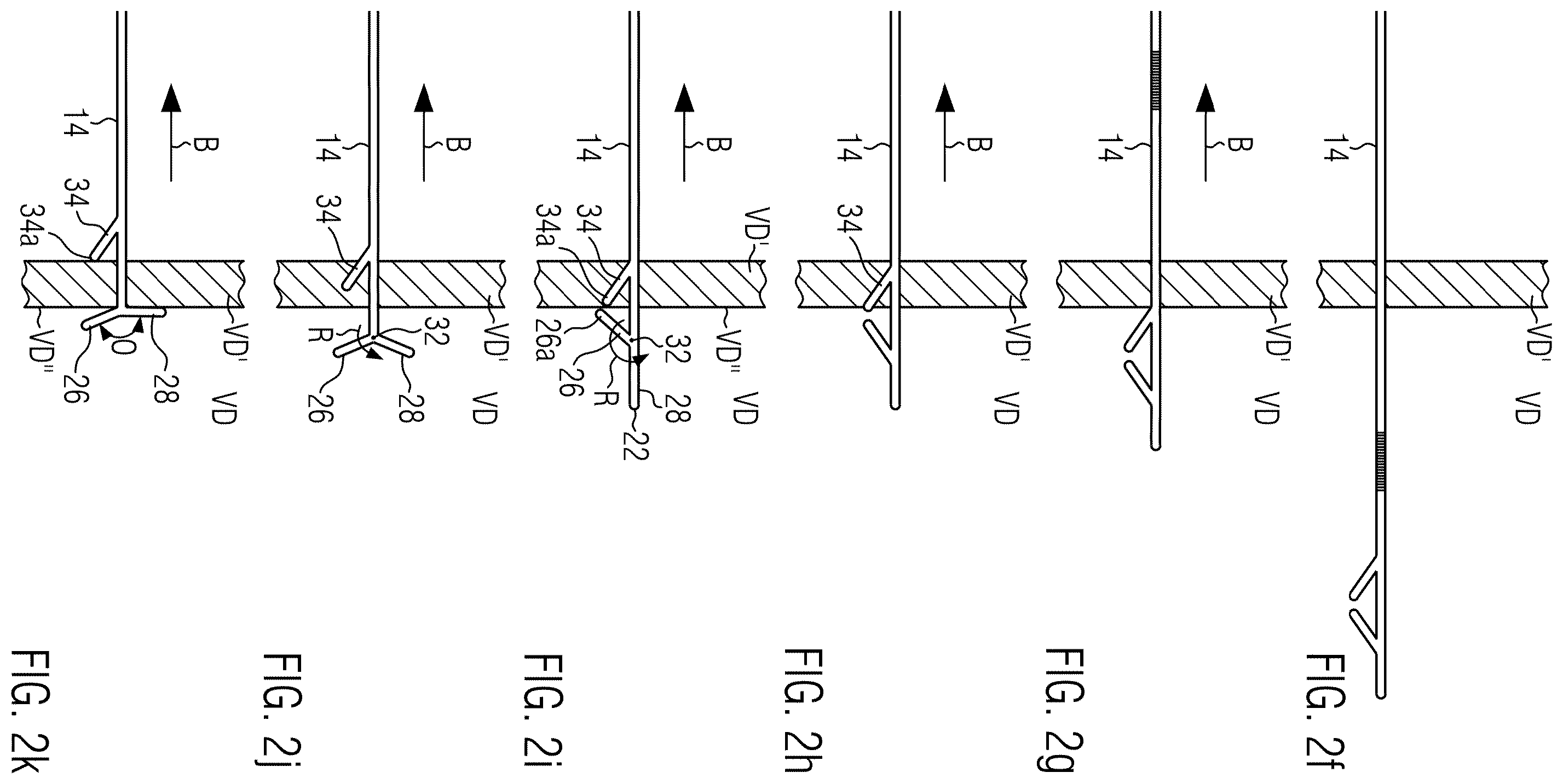 Patent US12564713 Figure 4 – Assembly of an implanting accessory and a flexible implantable stimulation lead