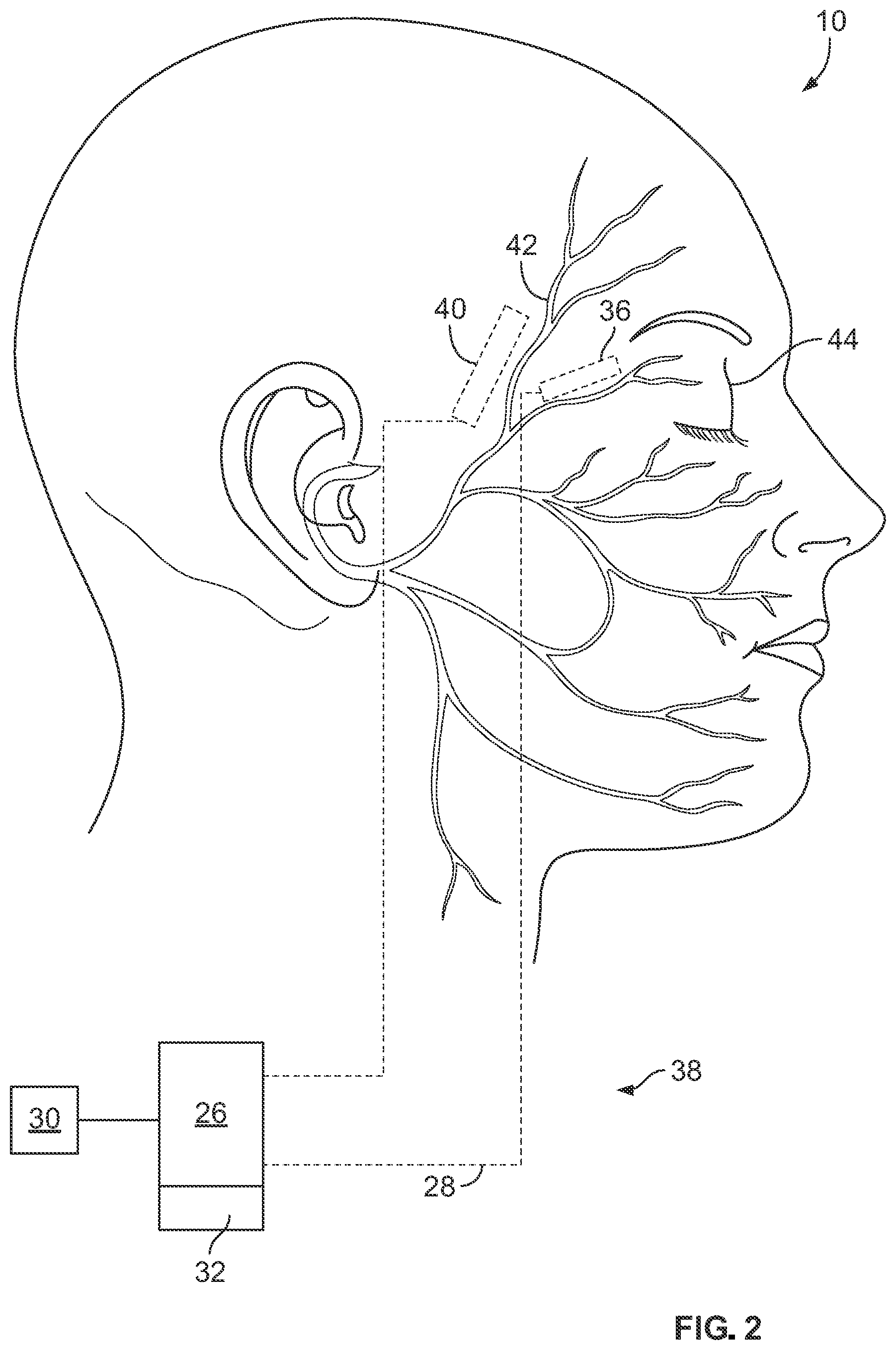Patent US12564716 Figure 2 – Tonic eyelid closure and blink pacing device and method