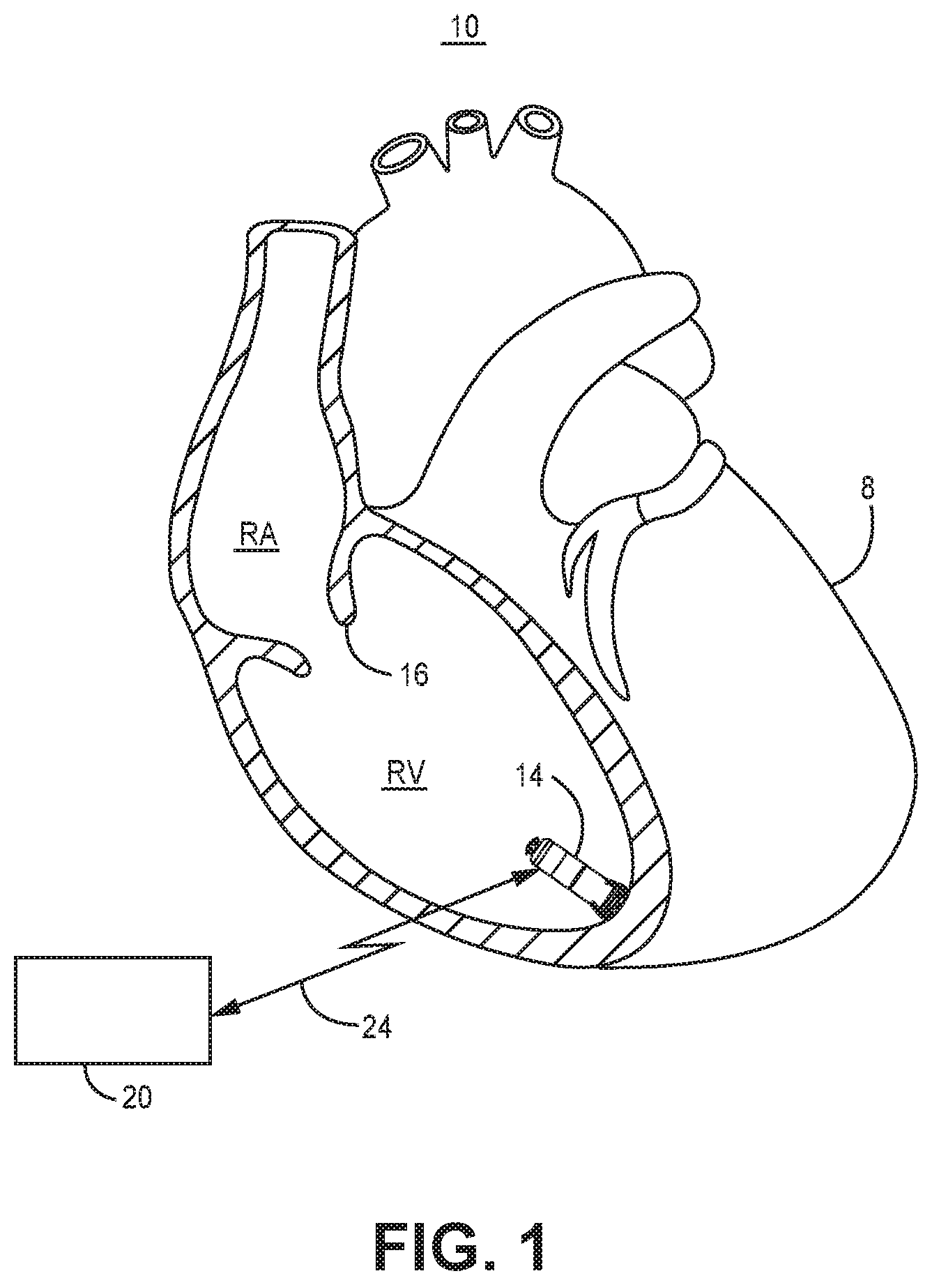 Patent US12564720 — Method and apparatus for atrial event detection — Figure 1