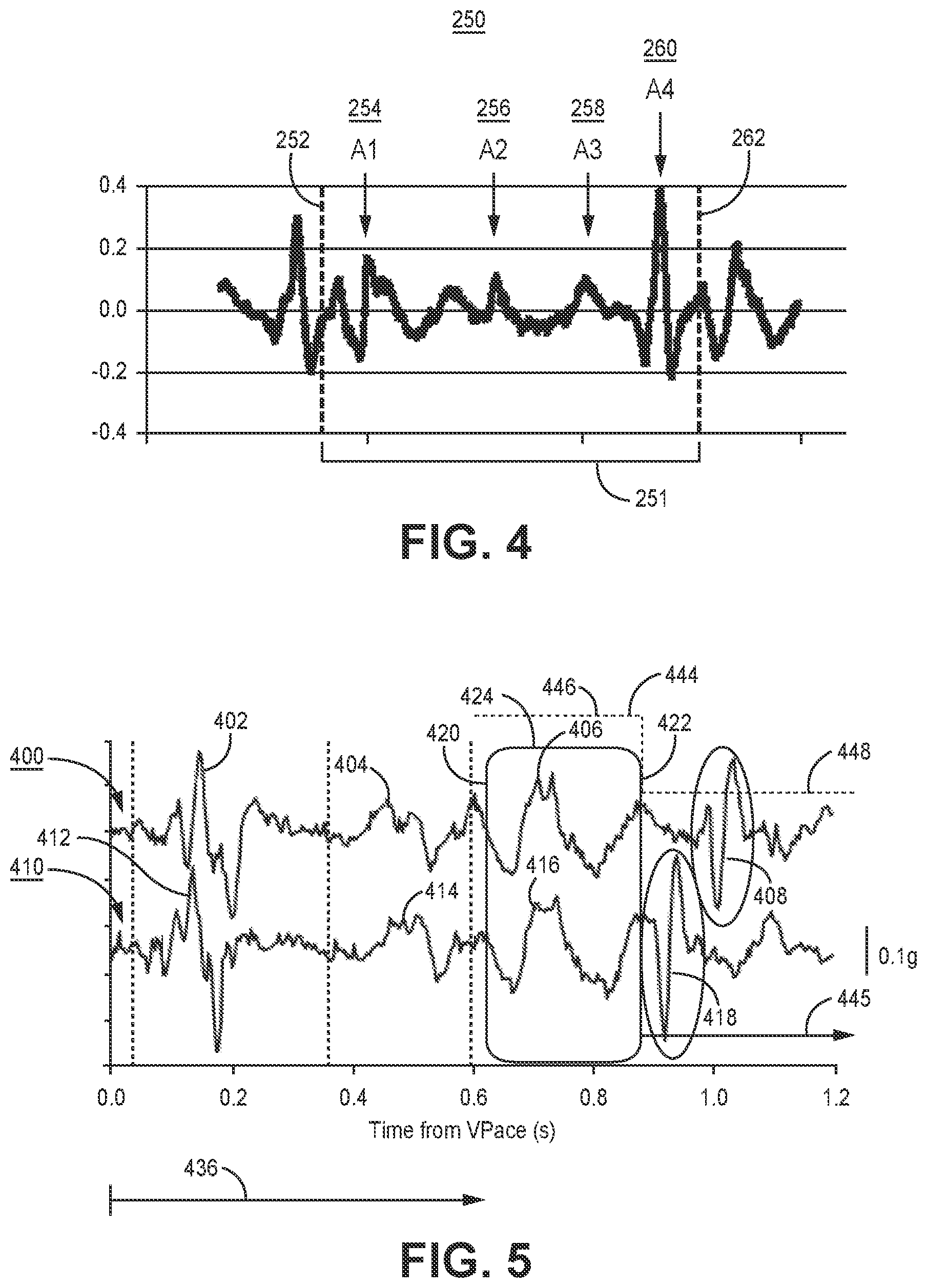 Patent US12564720 Figure 4 – Method and apparatus for atrial event detection
