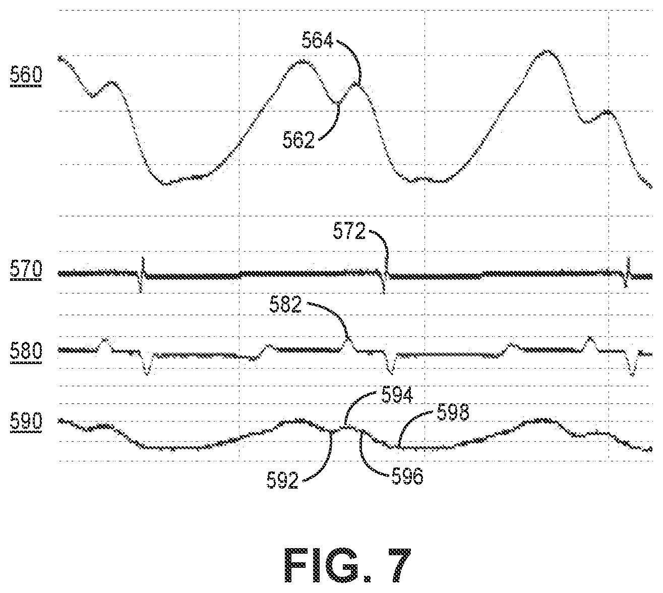 Patent US12564720 Figure 6 – Method and apparatus for atrial event detection