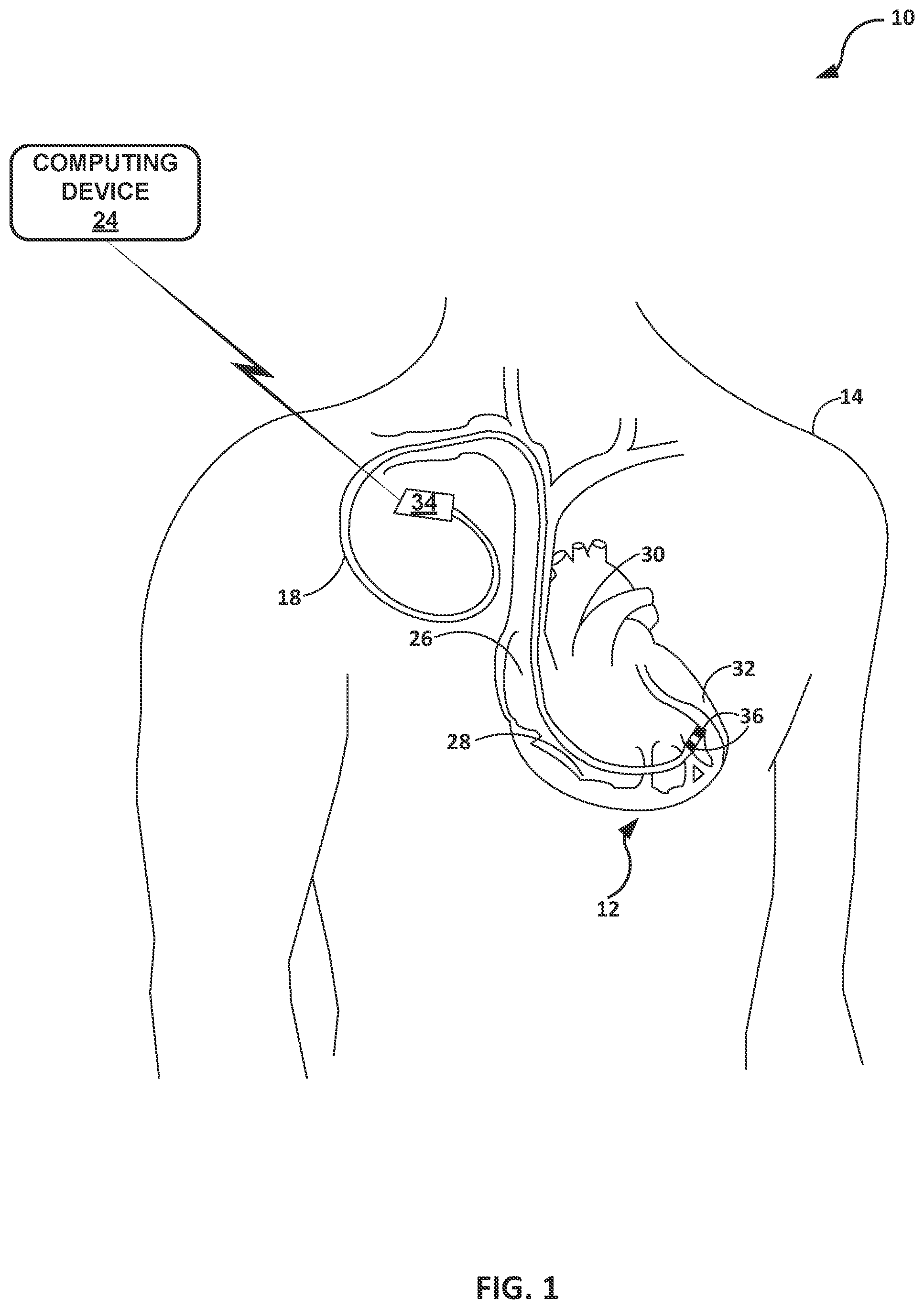 Patent US12564721 Figure 1 – Assessing pacemaker dependency