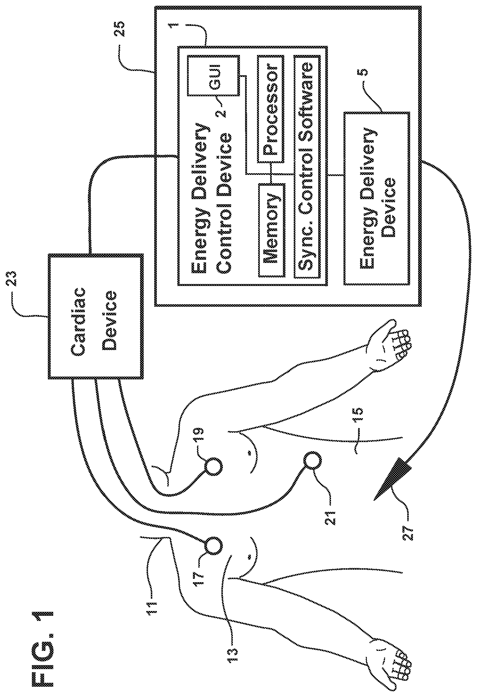 Patent US12564722 Figure 1 – System and method for synchronizing energy delivery to the cardiac rhythm