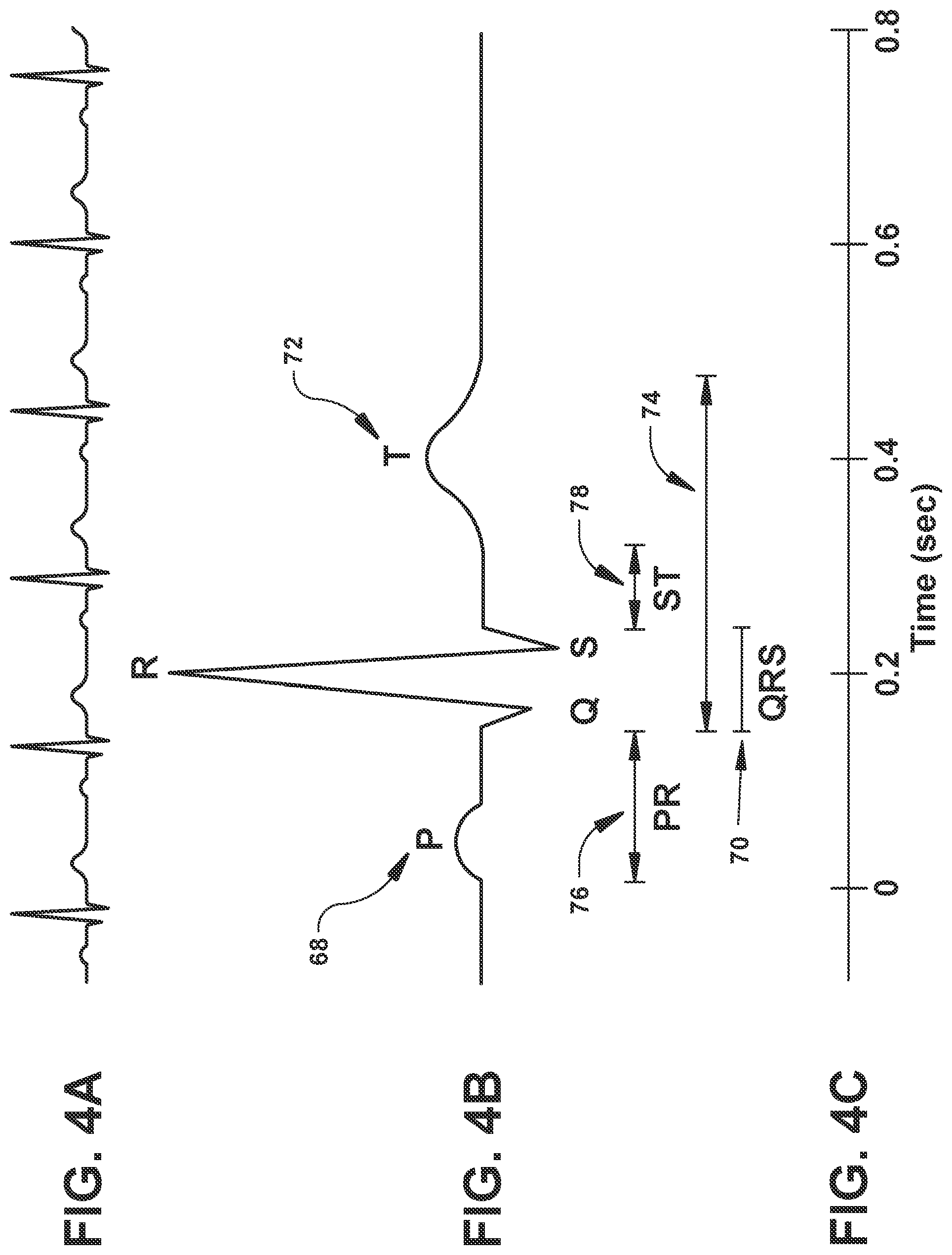 Patent US12564722 Figure 5 – System and method for synchronizing energy delivery to the cardiac rhythm