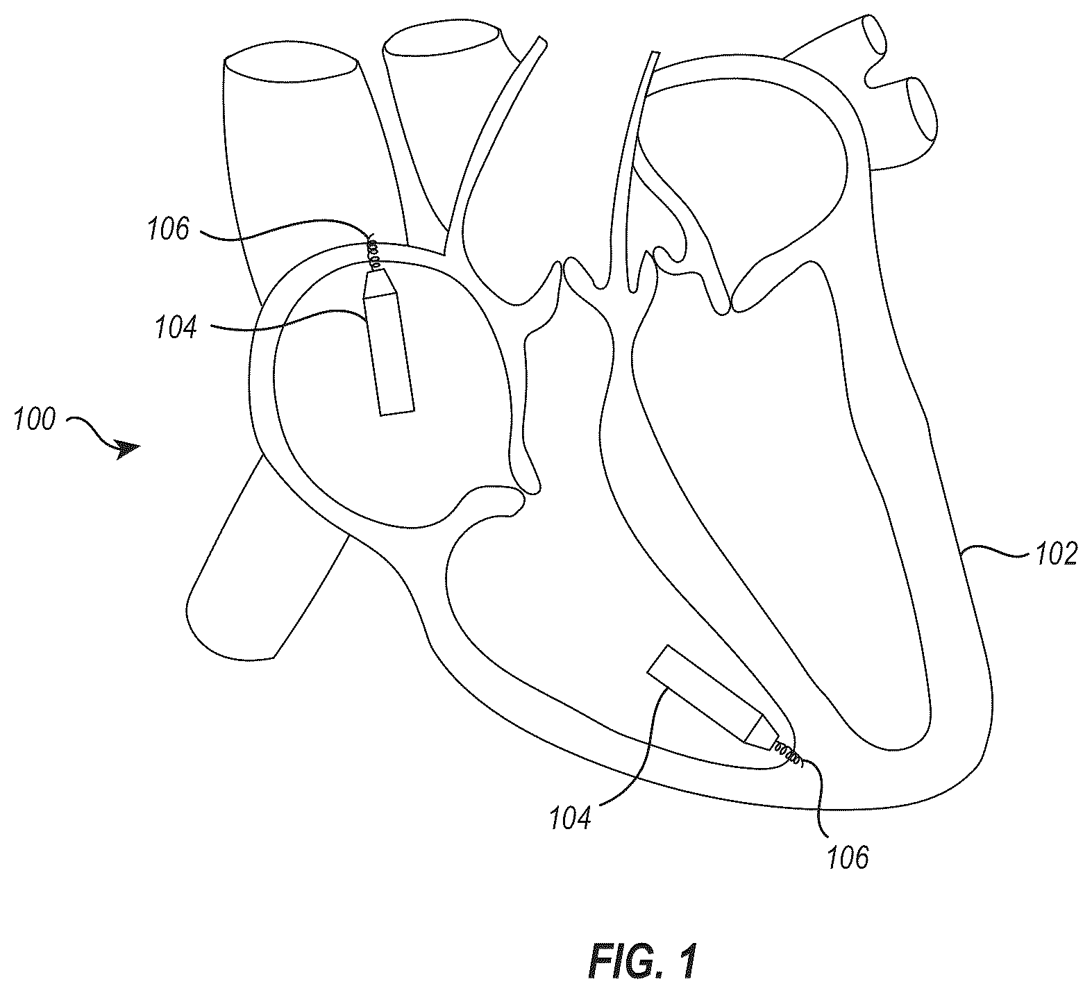 Patent US12564723 Figure 1 – Implant delivery and retrieval systems and methods
