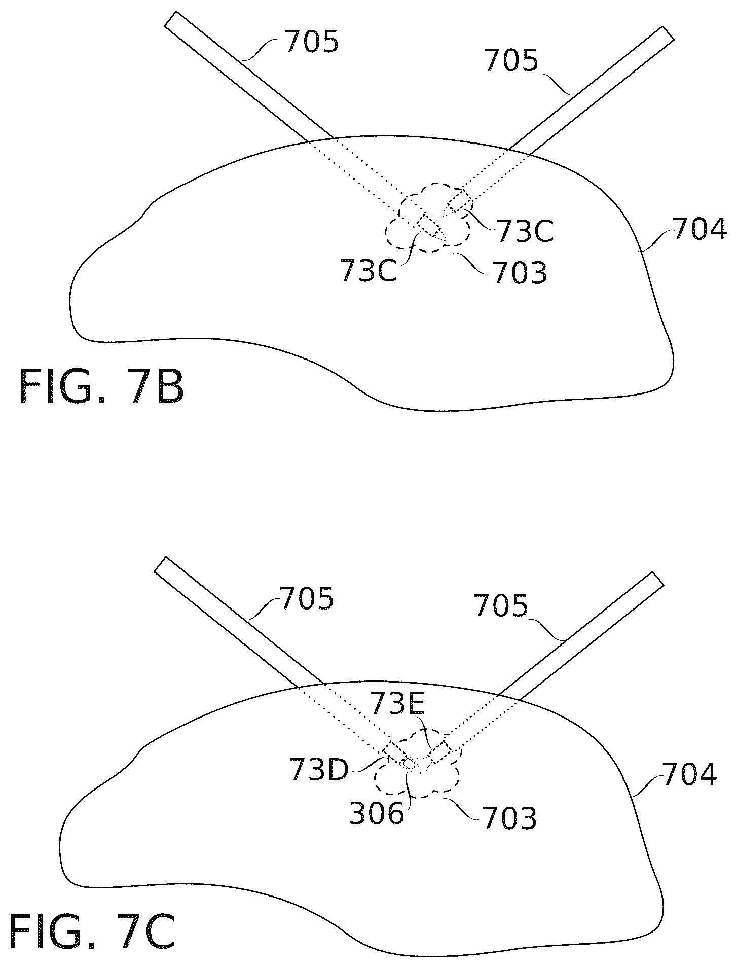 Patent US12564725 Figure 11 – Treatment of internal spaces using plasma generating device