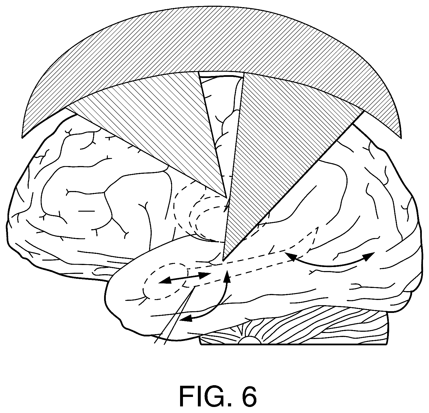 Patent US12564735 Figure 6 – Systems and methods for modulation and mapping of brain tissue using an ultrasound assembly