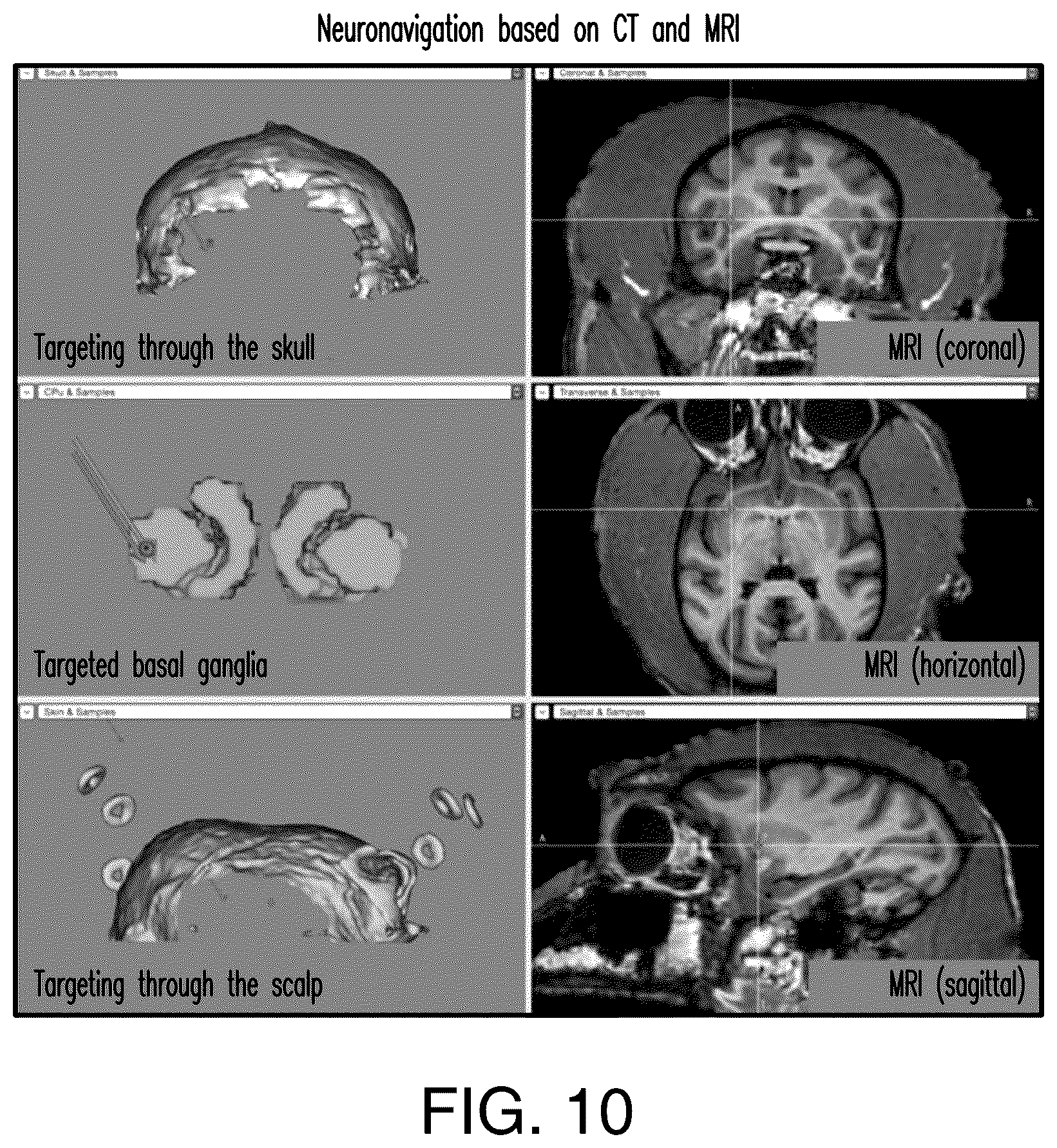 Patent US12564735 Figure 10 – Systems and methods for modulation and mapping of brain tissue using an ultrasound assembly