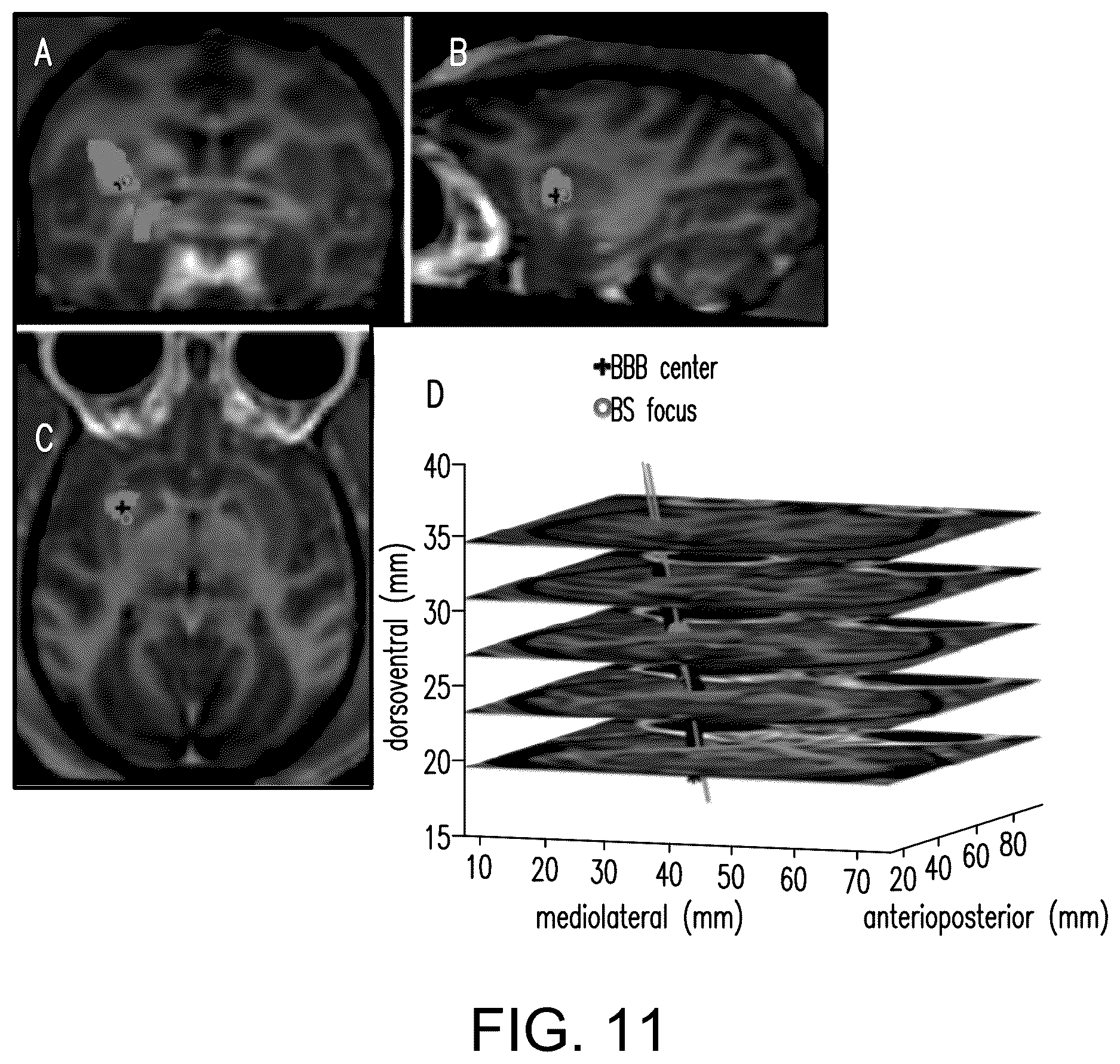 Patent US12564735 Figure 11 – Systems and methods for modulation and mapping of brain tissue using an ultrasound assembly