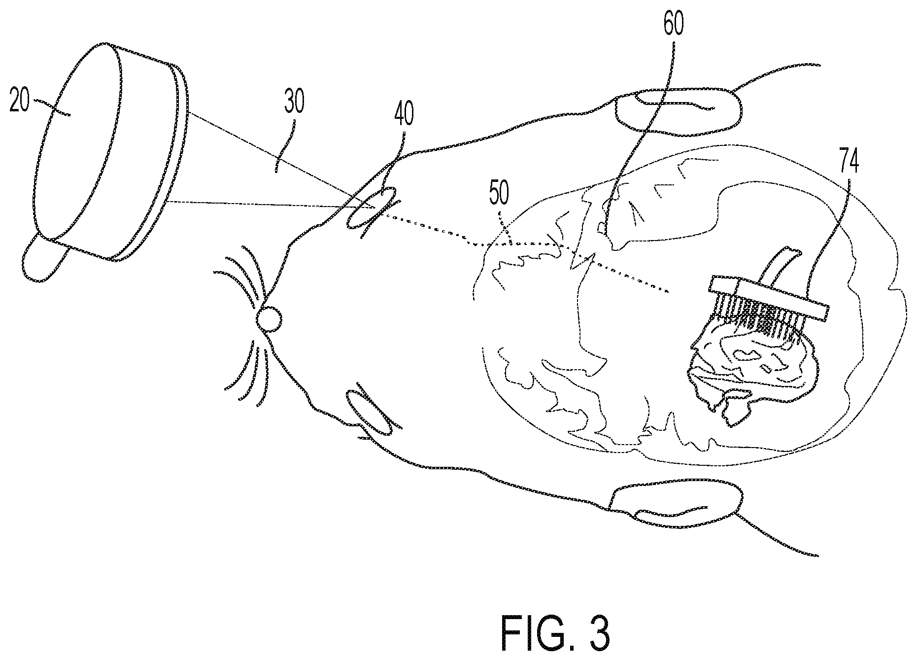 Patent US12564736 Figure 4 – Non-invasive ultrasound neuromodulation for vision restoration from retinal diseases