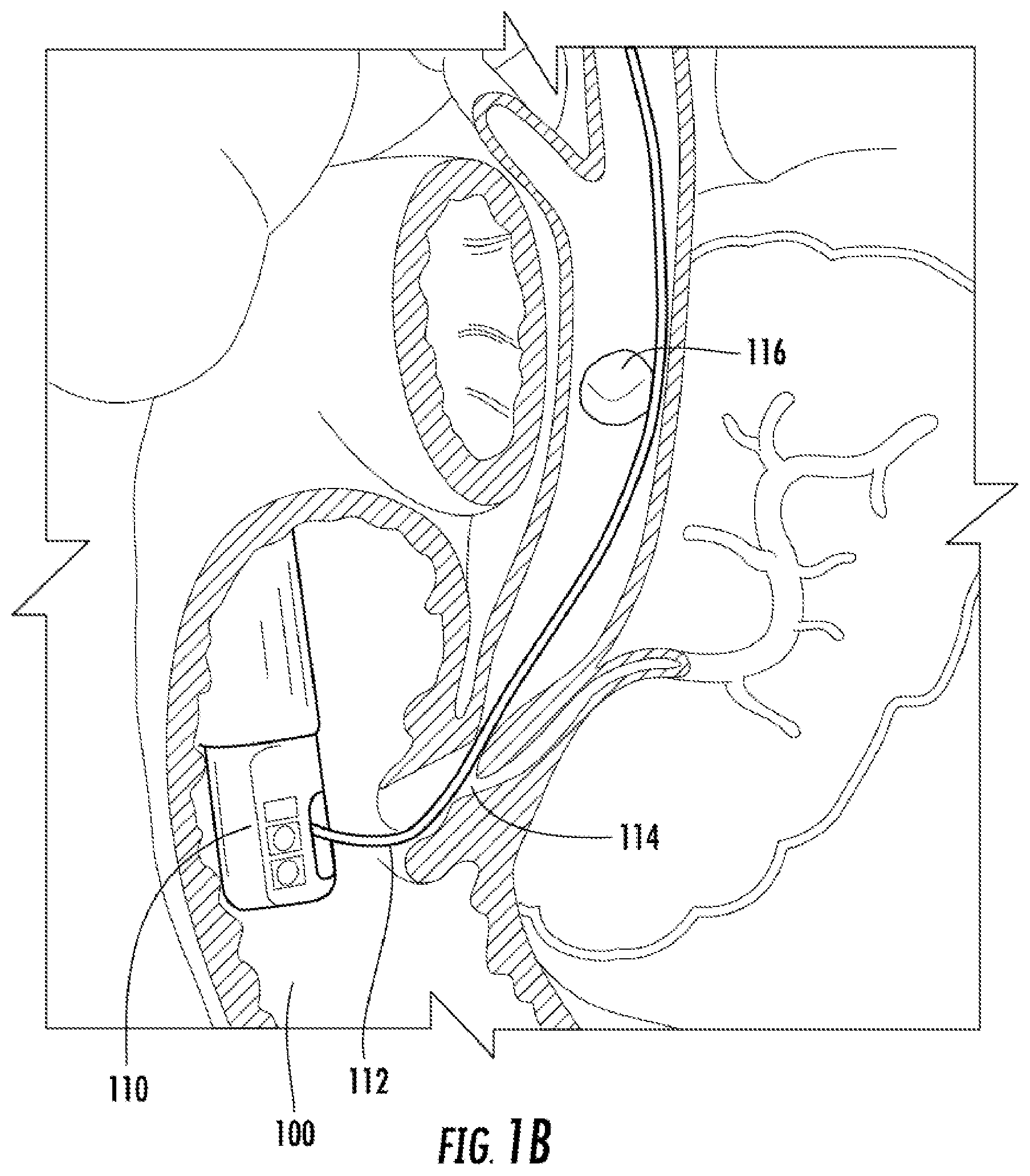 Patent US12569123 Figure 2 – Expandable guide devices, systems, and methods