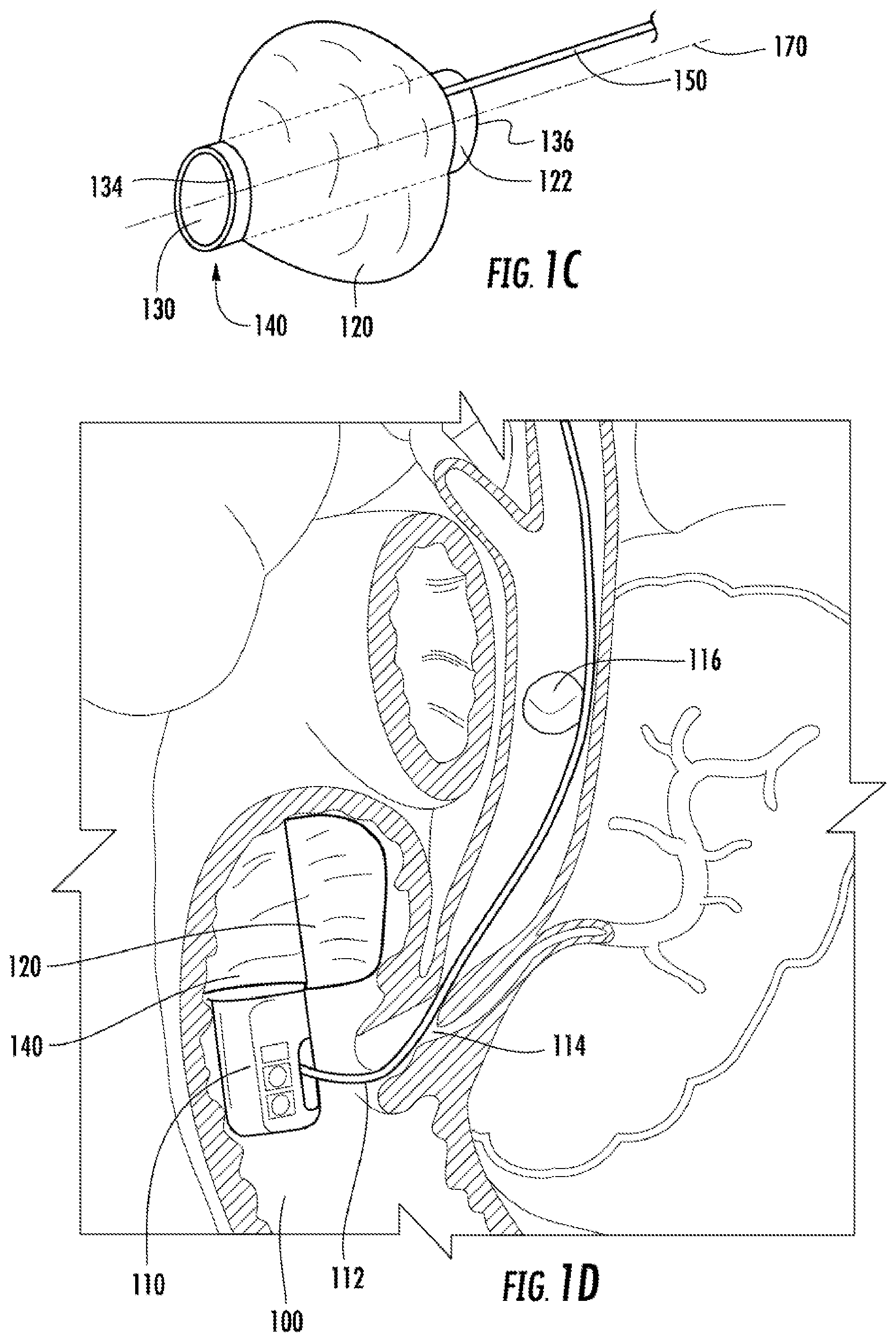 Patent US12569123 Figure 3 – Expandable guide devices, systems, and methods