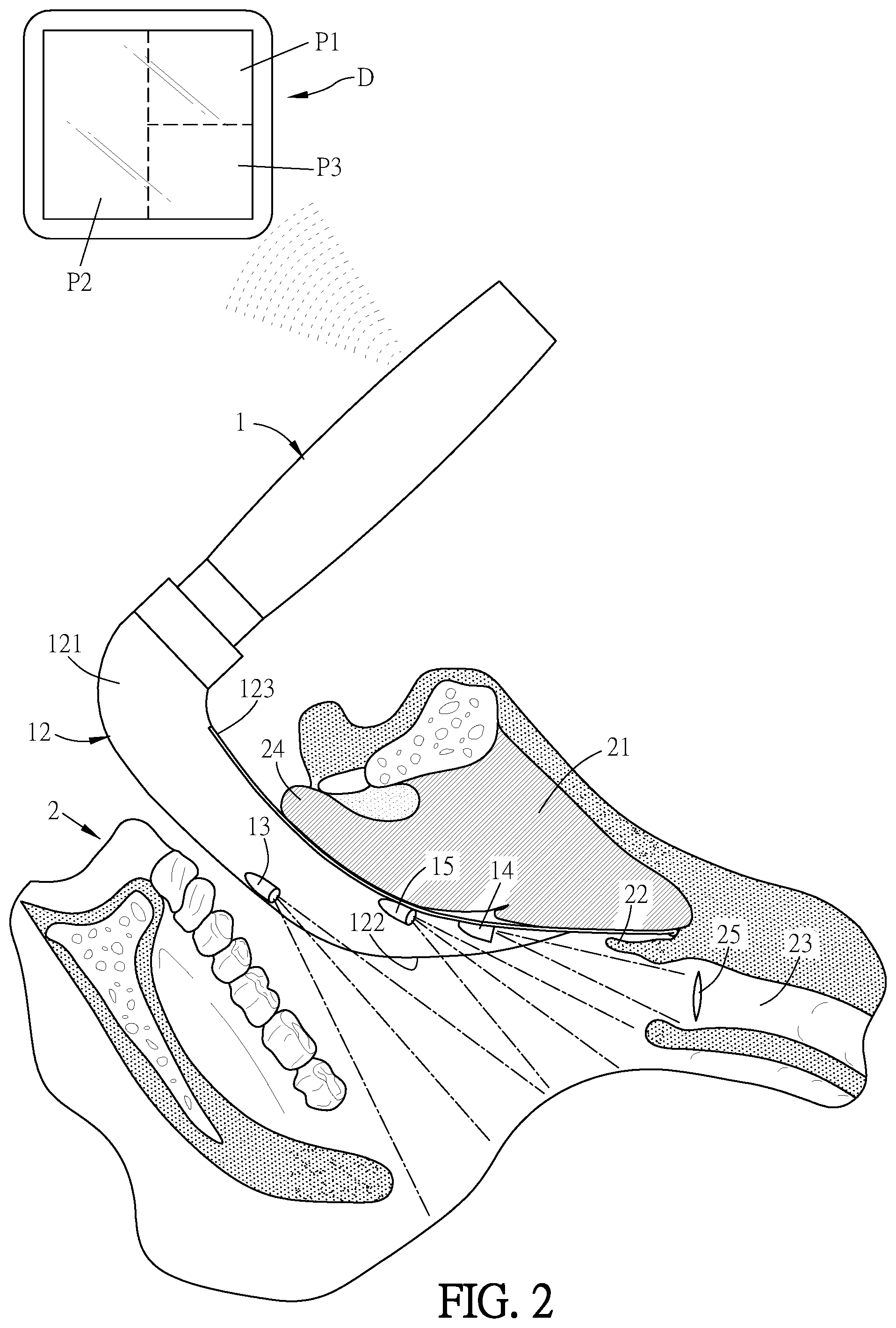 Patent US12569127 Figure 6 – Multi-view video laryngoscope, and spatula blade configured with multiple image capturing apparatuses