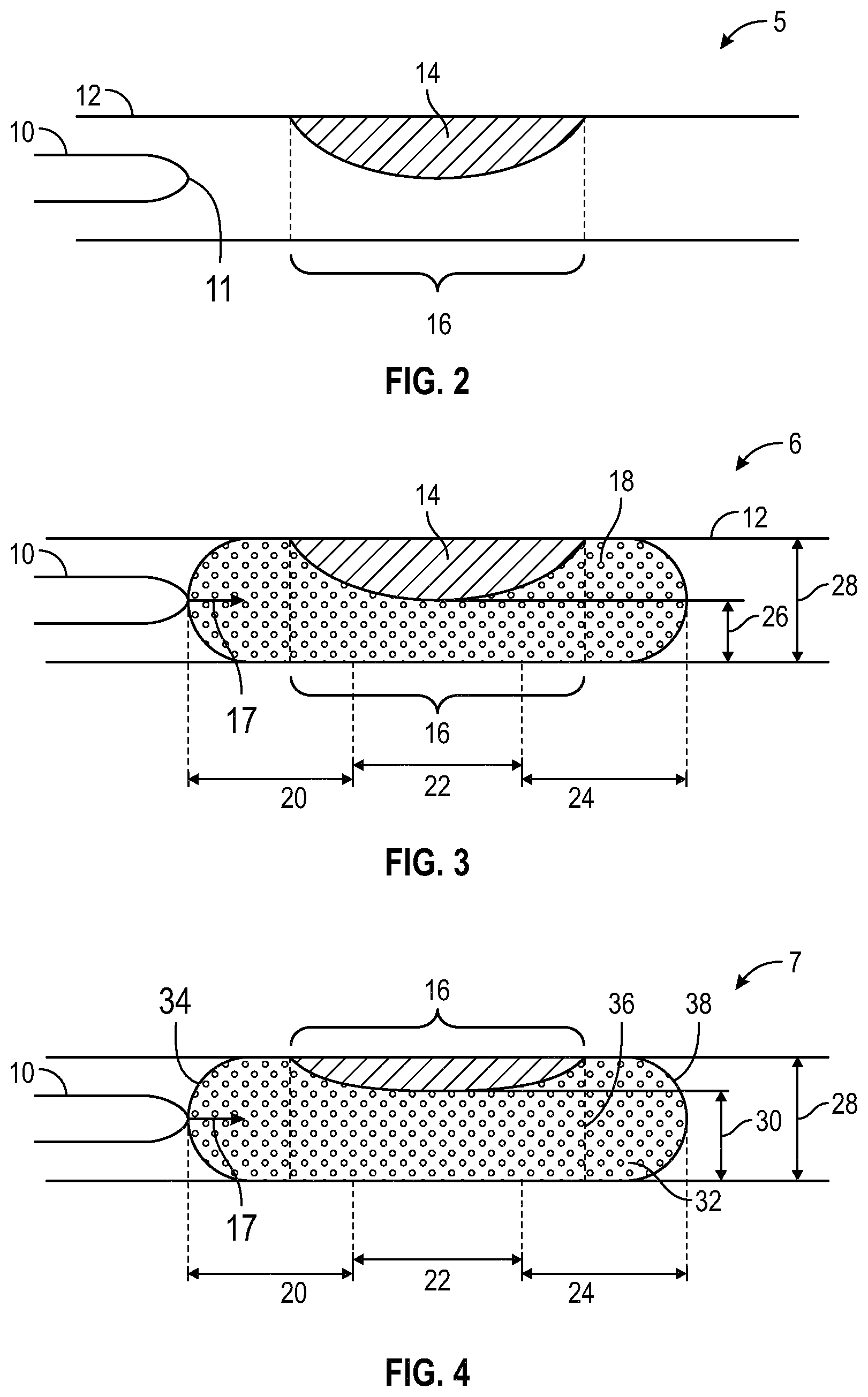 Patent US12569141 Figure 2 – Systems and methods for laser catheter treatment in a vessel lumen