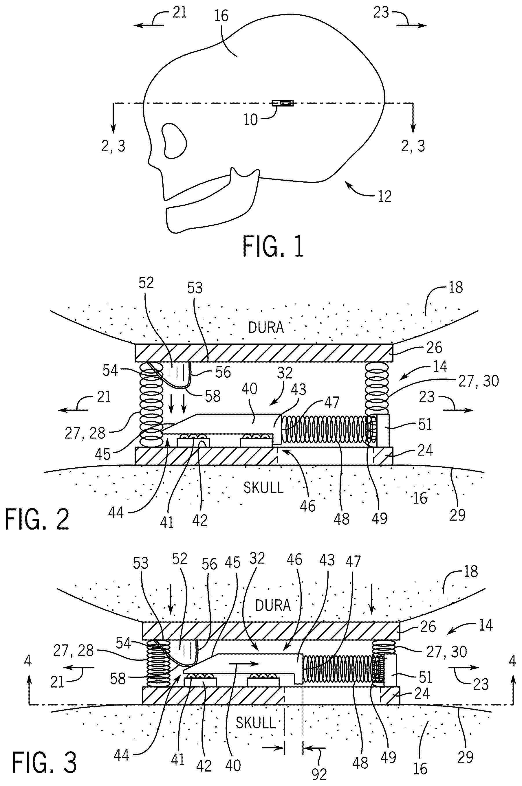 Patent US12569155 Figure 1 – Implantable pressure sensing device for longitudinal intracranial pressure monitoring