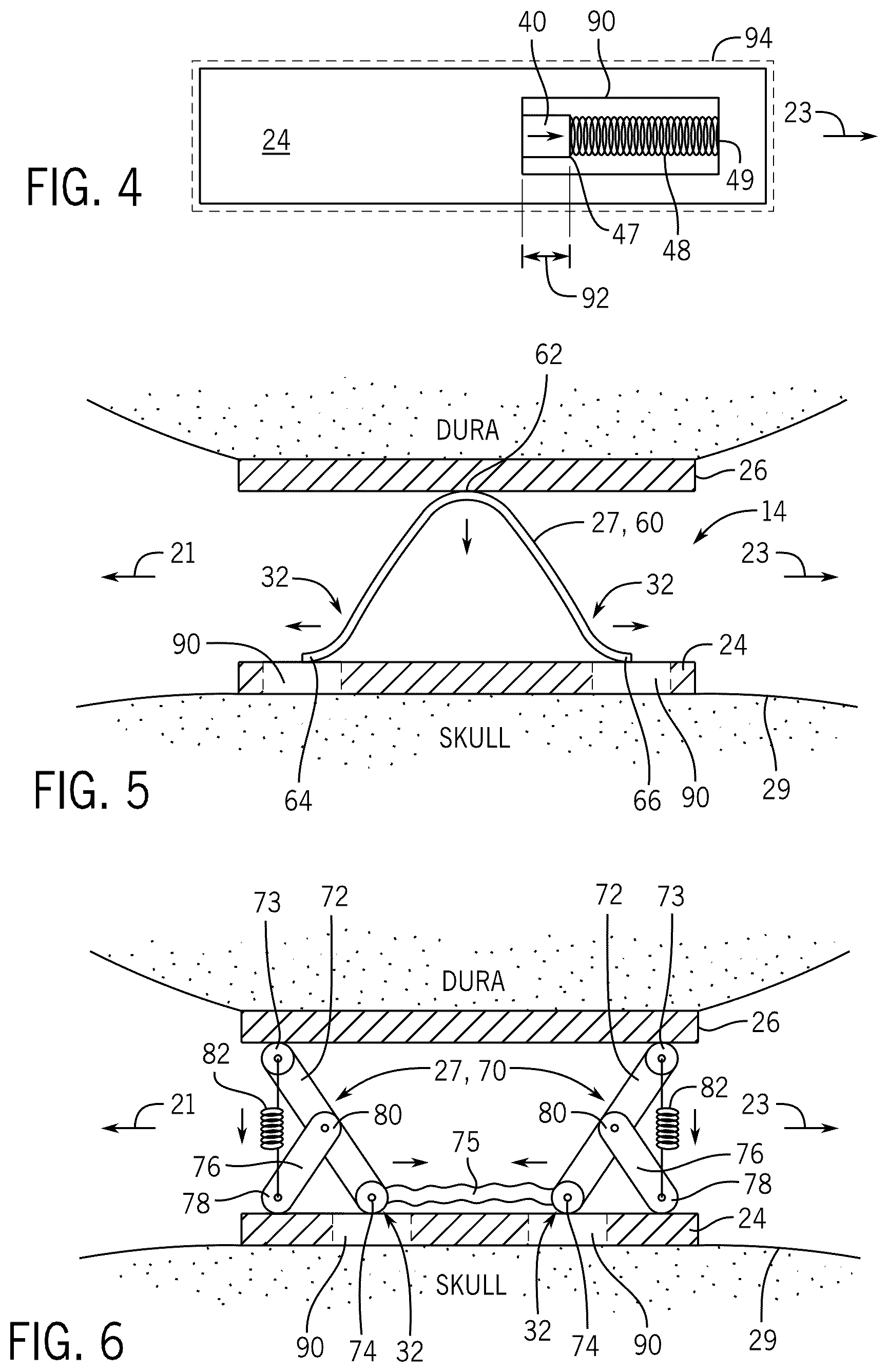 Patent US12569155 Figure 2 – Implantable pressure sensing device for longitudinal intracranial pressure monitoring