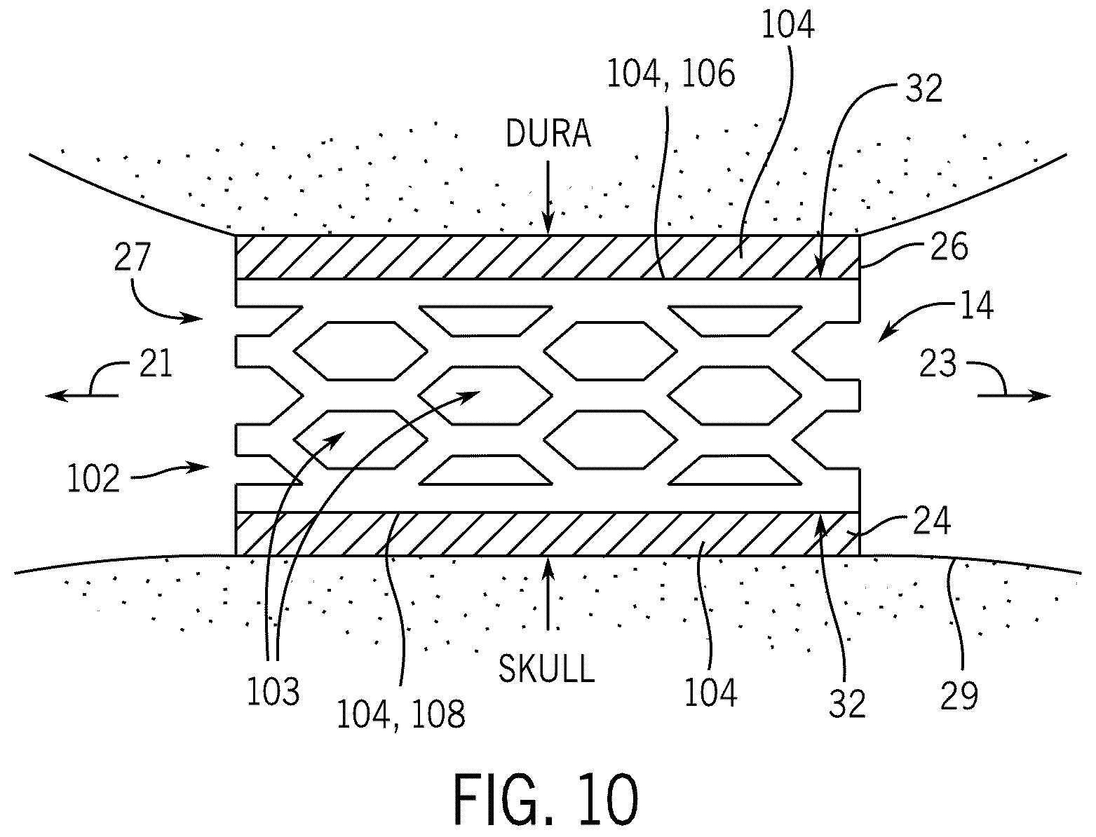 Patent US12569155 Figure 4 – Implantable pressure sensing device for longitudinal intracranial pressure monitoring