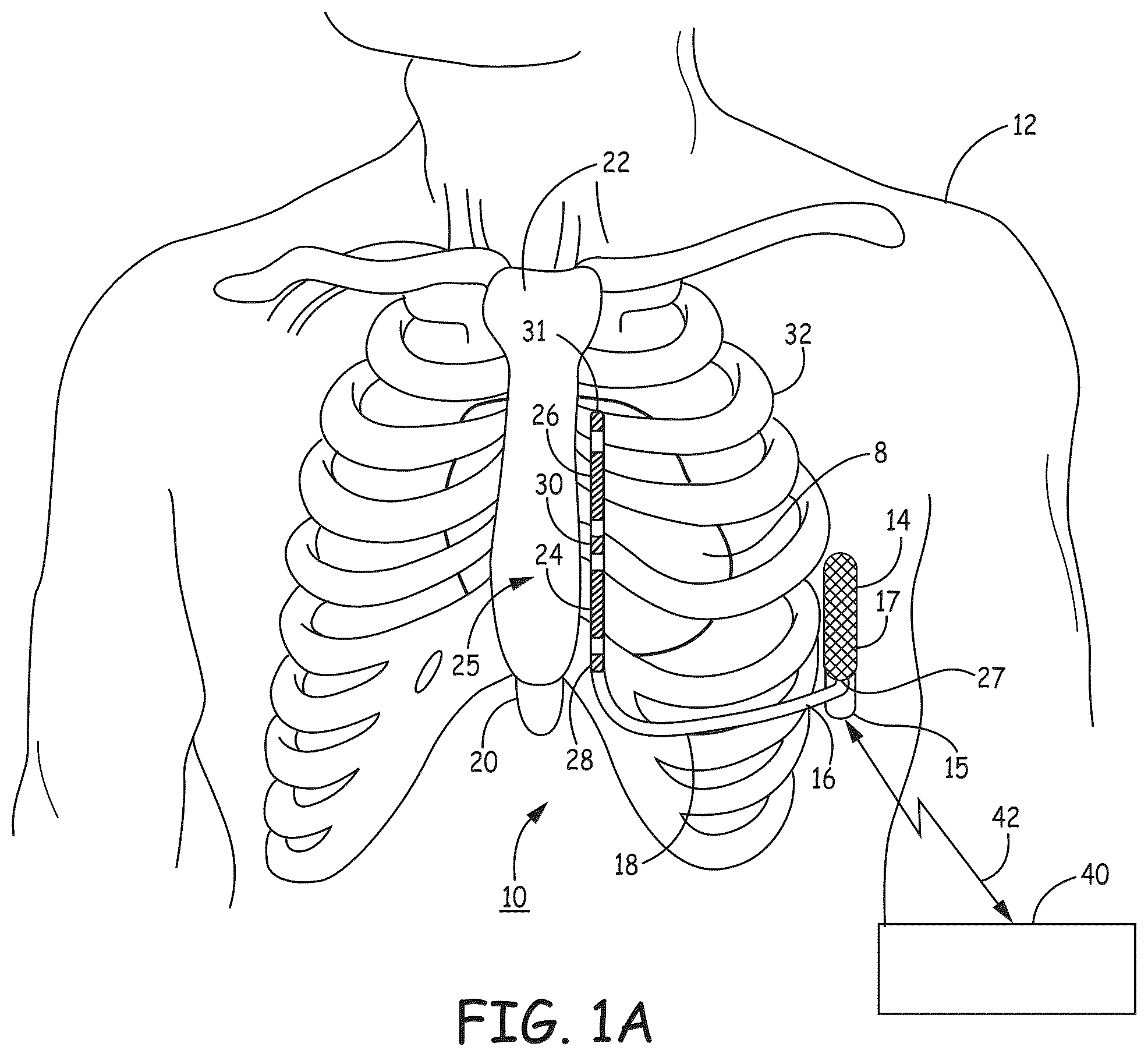 Patent US12569184 Figure 1 – Cardiac electrical signal gross morphology-based noise detection for rejection of ventricular tachyarrhythmia detection