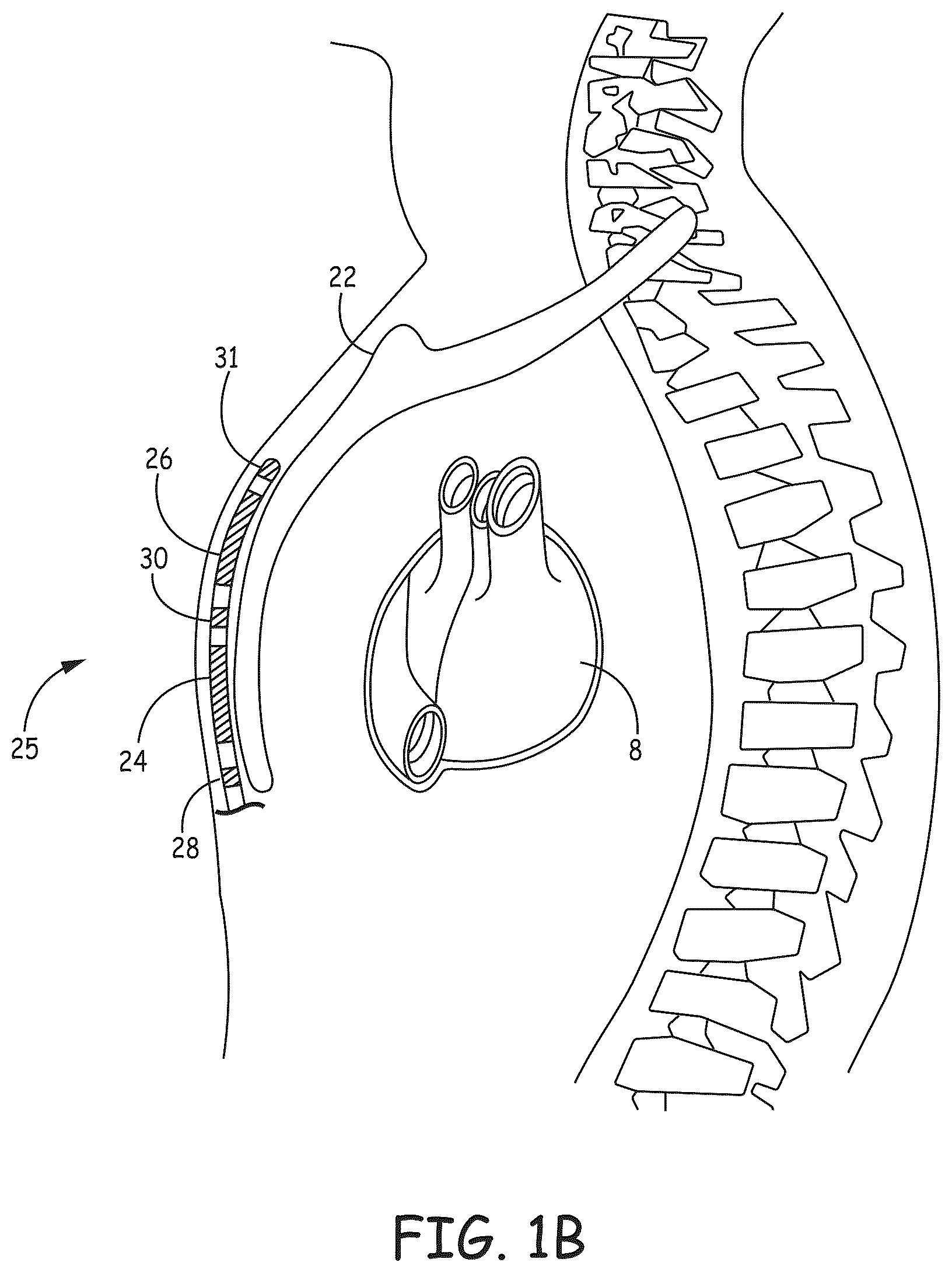 Patent US12569184 Figure 2 – Cardiac electrical signal gross morphology-based noise detection for rejection of ventricular tachyarrhythmia detection