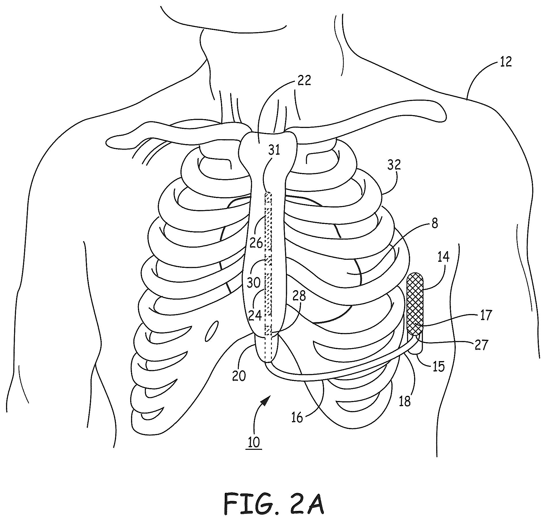 Patent US12569184 Figure 3 – Cardiac electrical signal gross morphology-based noise detection for rejection of ventricular tachyarrhythmia detection