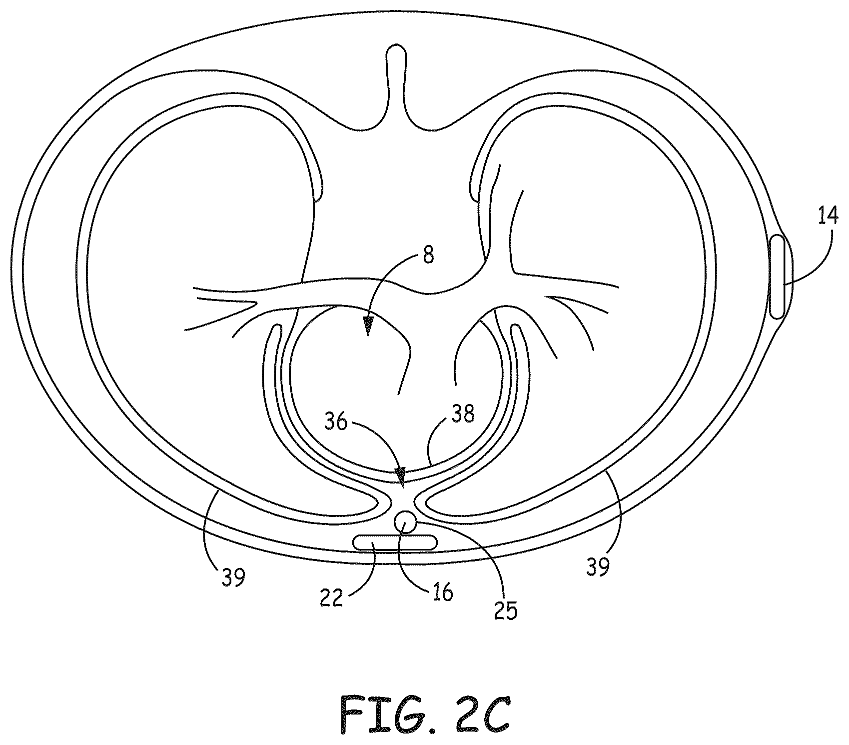 Patent US12569184 Figure 5 – Cardiac electrical signal gross morphology-based noise detection for rejection of ventricular tachyarrhythmia detection