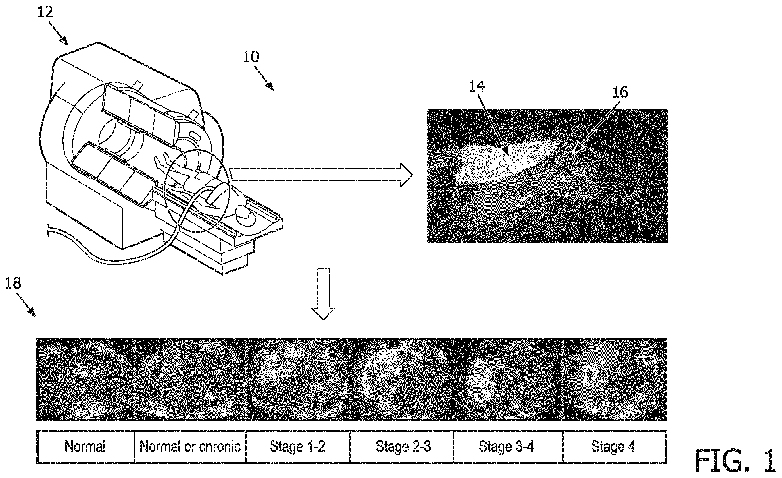 Patent US12569186 Figure 1 – Apparatus and method for augmented interpretation of magnetic resonance and ultrasound shear wave elastography for monitoring liver fibrosis