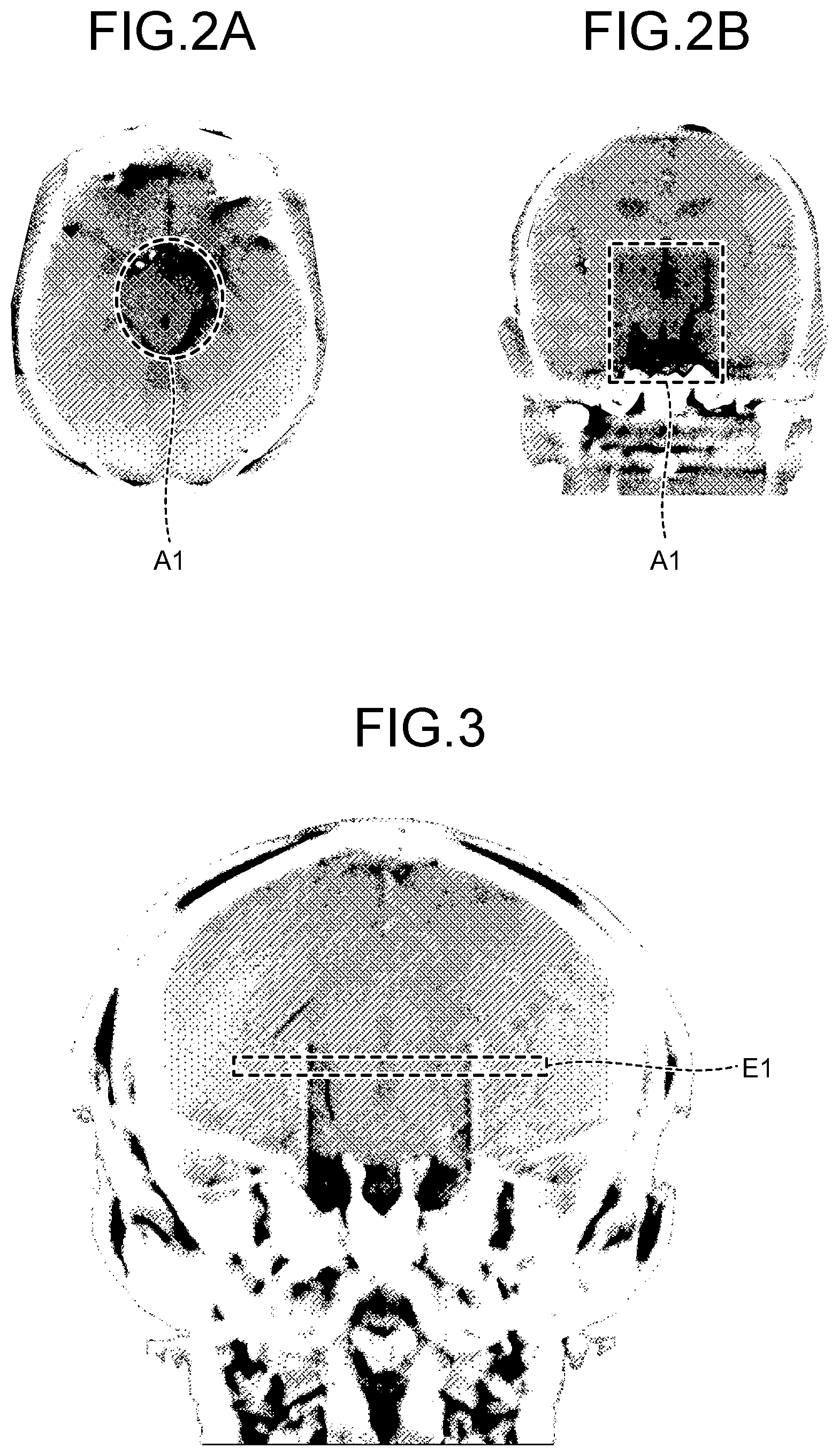 Patent US12569212 Figure 2 – Medical image processing apparatus, x-ray diagnostic apparatus, and medical image processing method