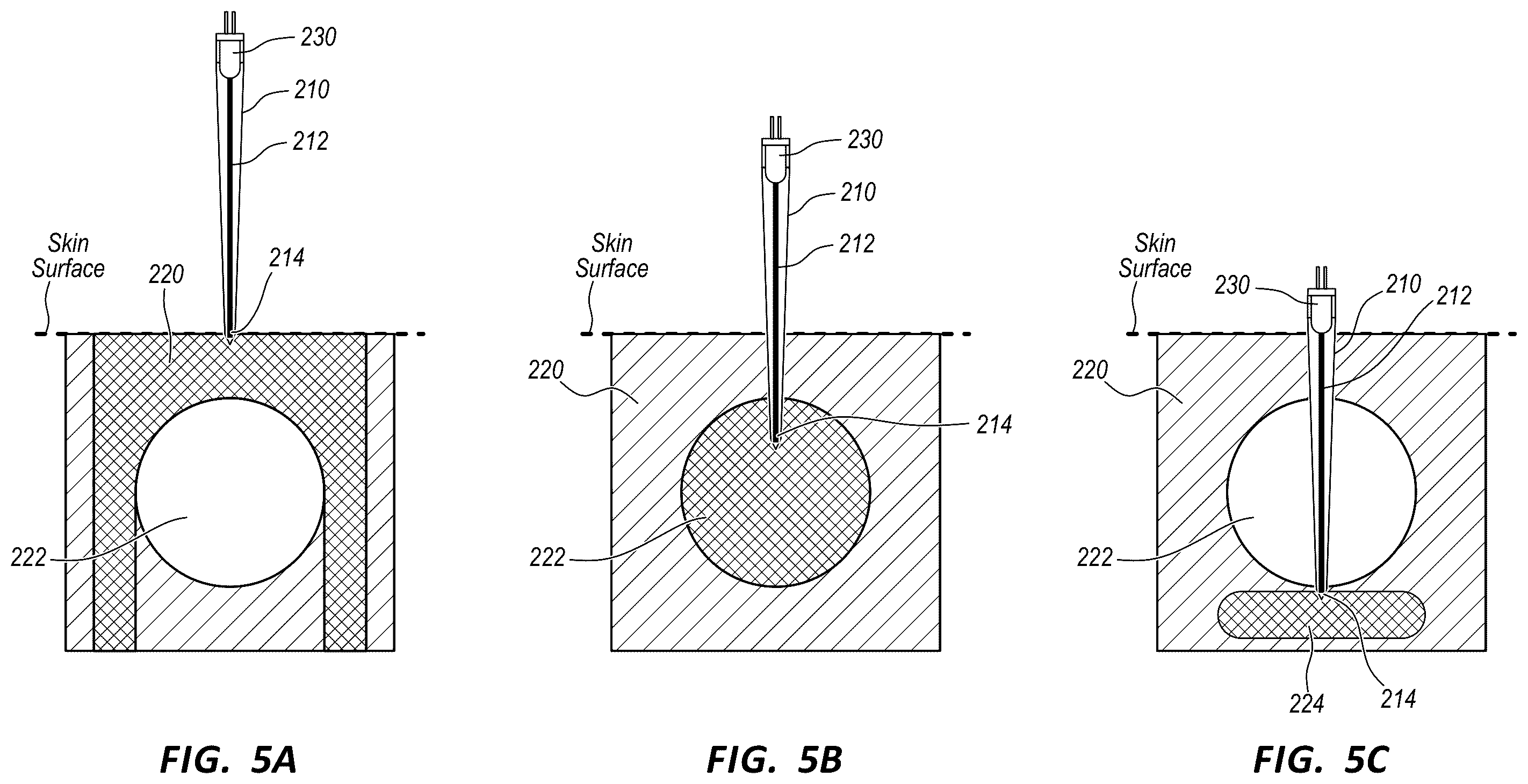 Patent US12569221 Figure 5 – Systems and methods for infrared-enhanced ultrasound visualization