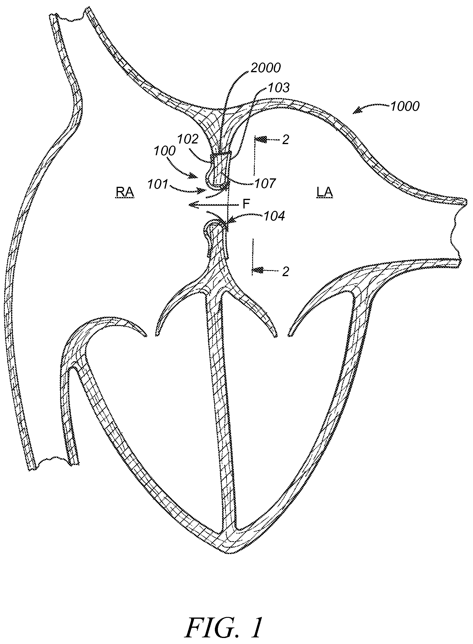 Patent US12569233 Figure 1 – Devices and methods for coronary sinus pressure relief