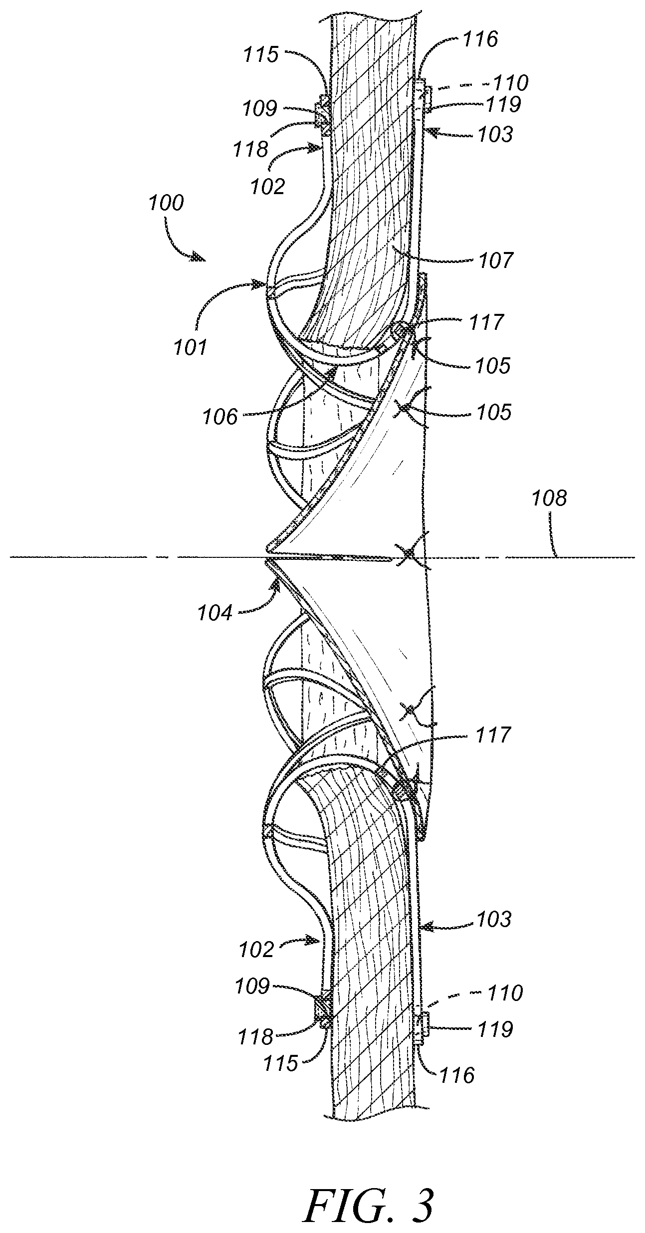 Patent US12569233 Figure 4 – Devices and methods for coronary sinus pressure relief