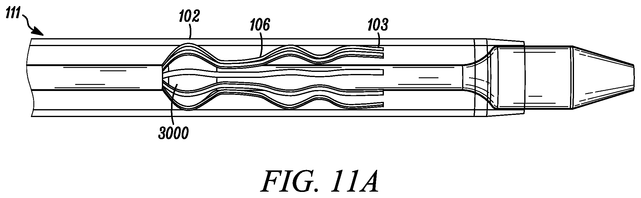 Patent US12569233 Figure 10 – Devices and methods for coronary sinus pressure relief