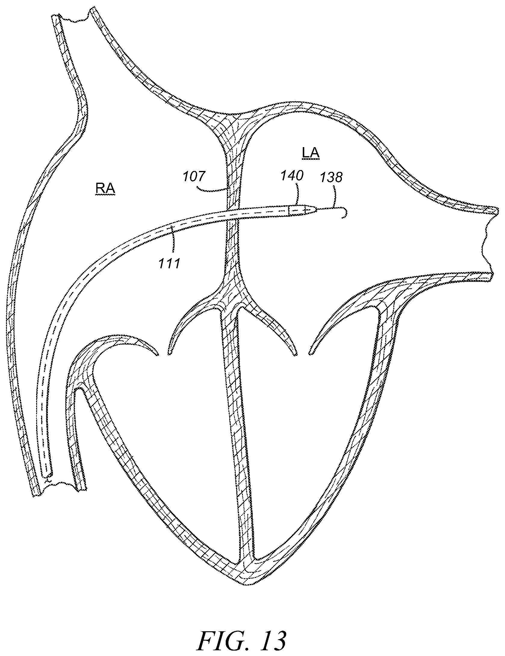 Patent US12569233 Figure 12 – Devices and methods for coronary sinus pressure relief