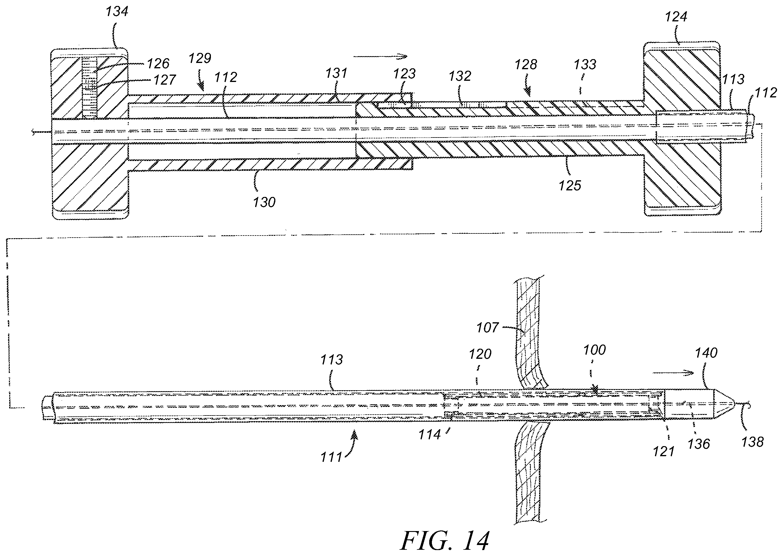 Patent US12569233 Figure 13 – Devices and methods for coronary sinus pressure relief