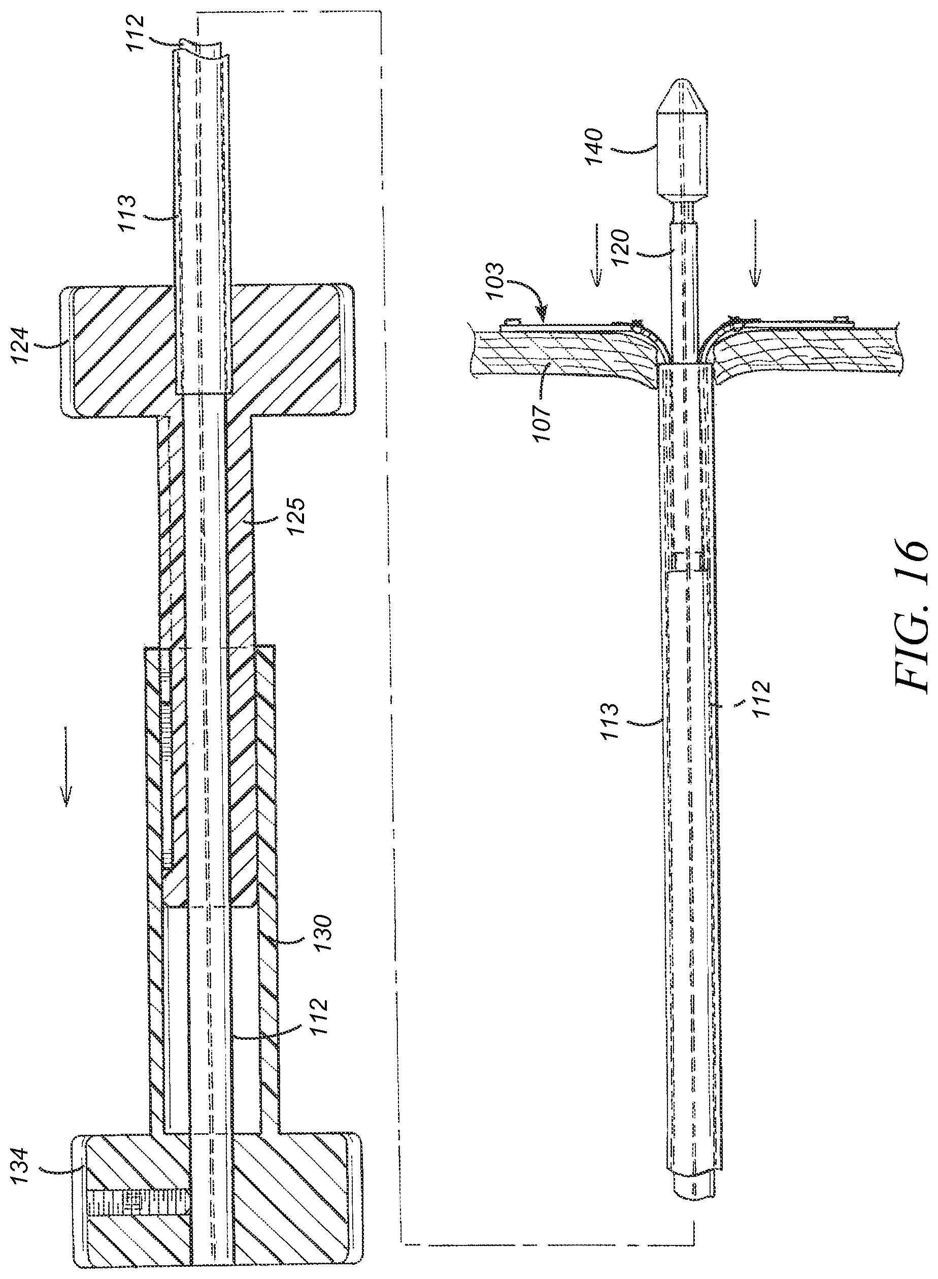 Patent US12569233 Figure 15 – Devices and methods for coronary sinus pressure relief