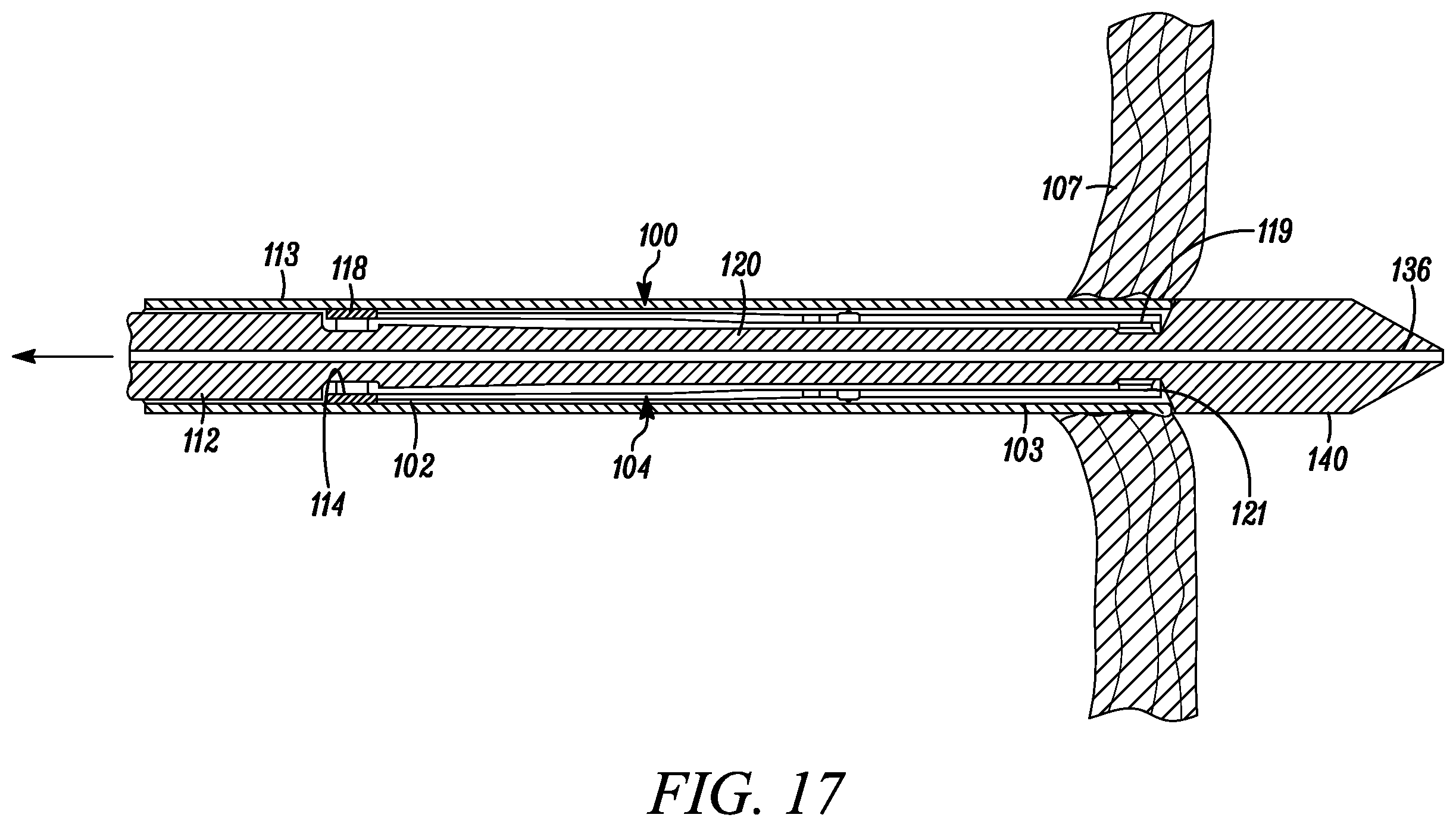 Patent US12569233 Figure 16 – Devices and methods for coronary sinus pressure relief