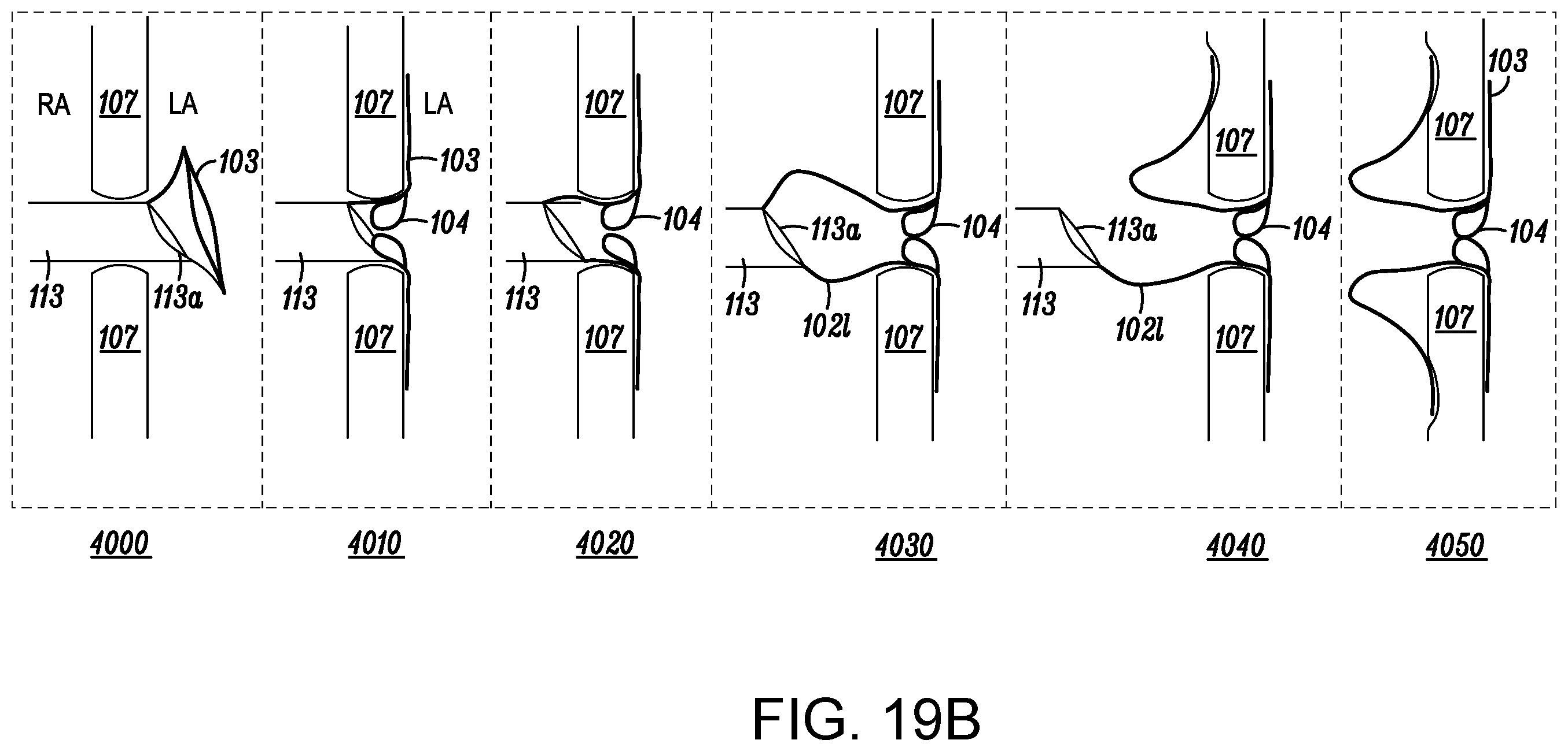Patent US12569233 Figure 19 – Devices and methods for coronary sinus pressure relief