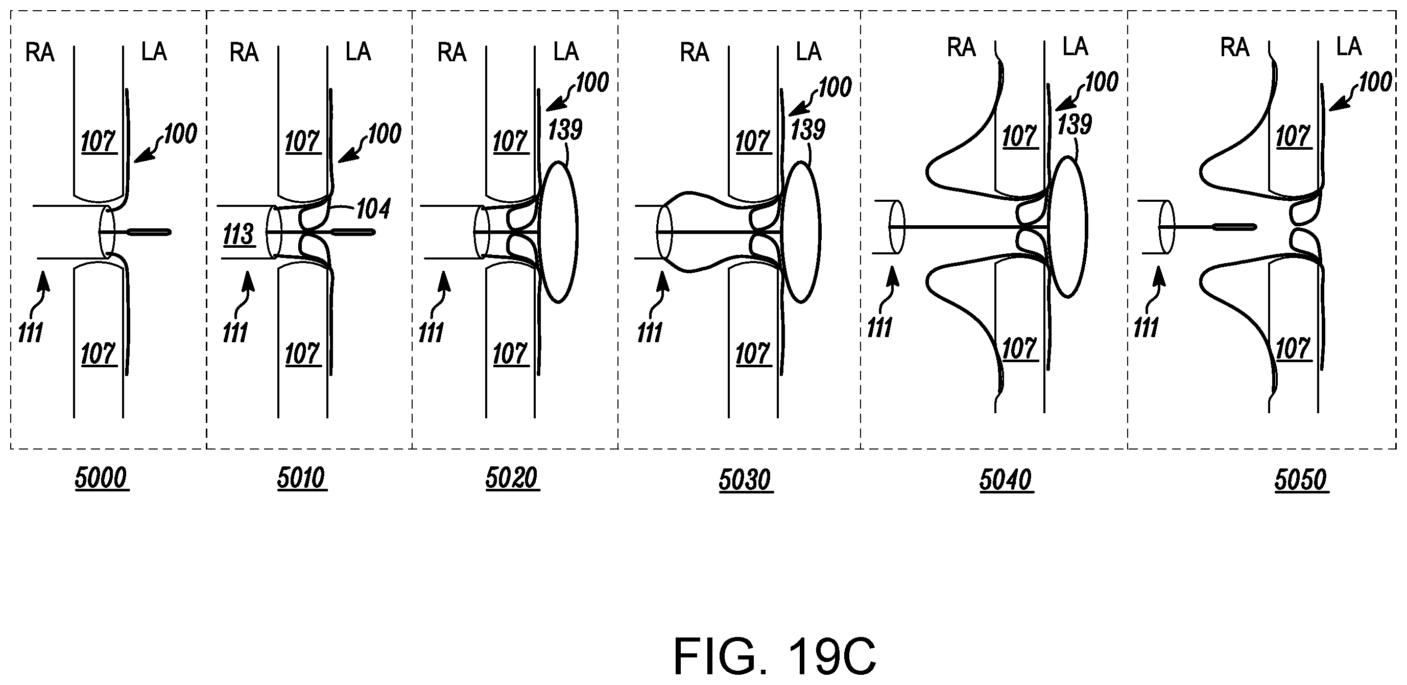Patent US12569233 Figure 20 – Devices and methods for coronary sinus pressure relief