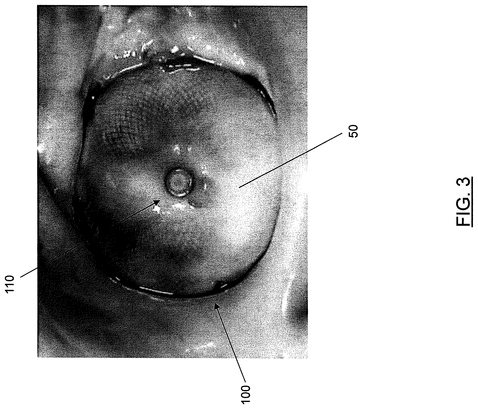 Patent US12569234 Figure 3 – Devices and methods for occluding abnormal openings in a patient's vasculature
