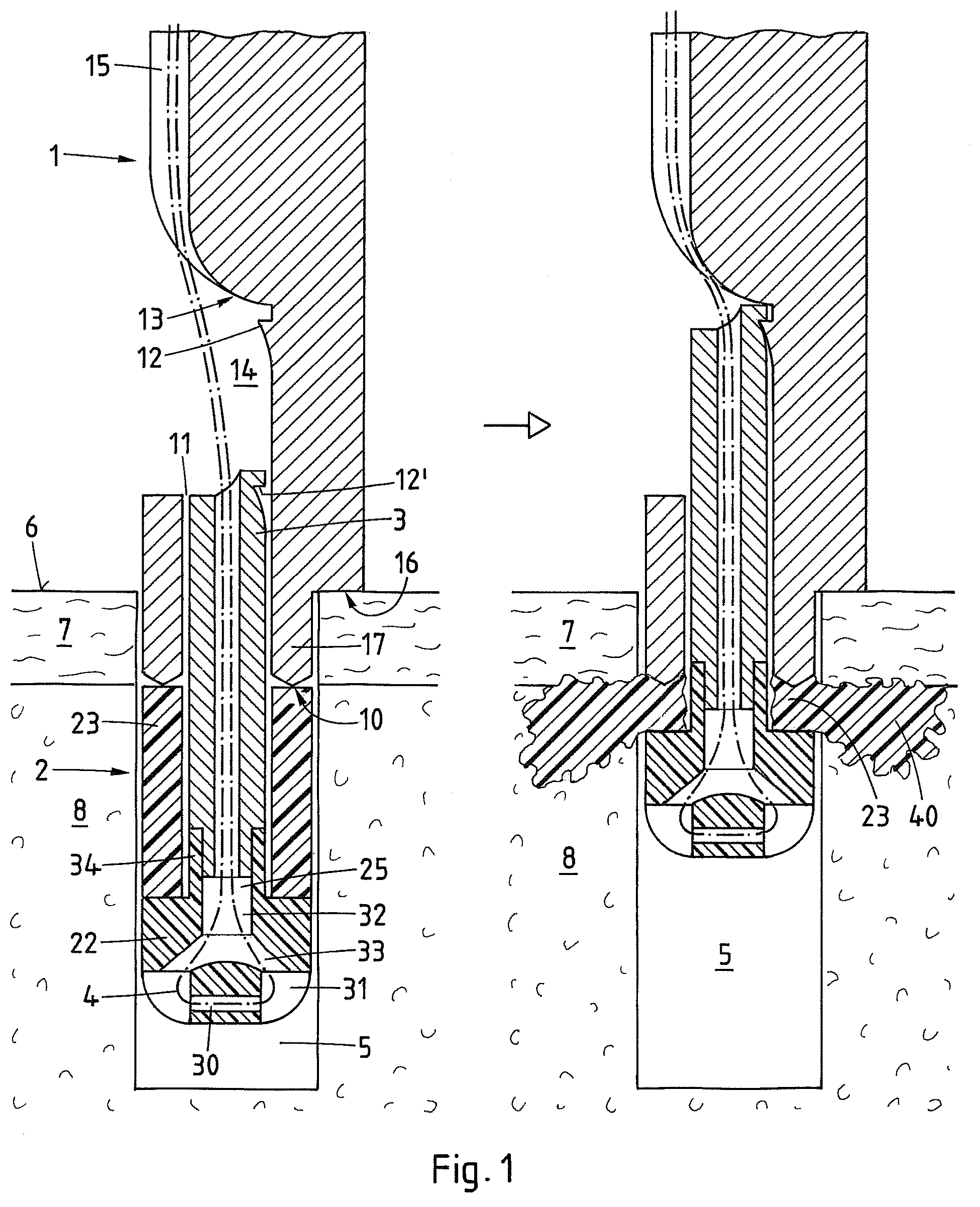 Patent US12569242 Figure 1 – Device and method for fixating a suture anchor in hard tissue