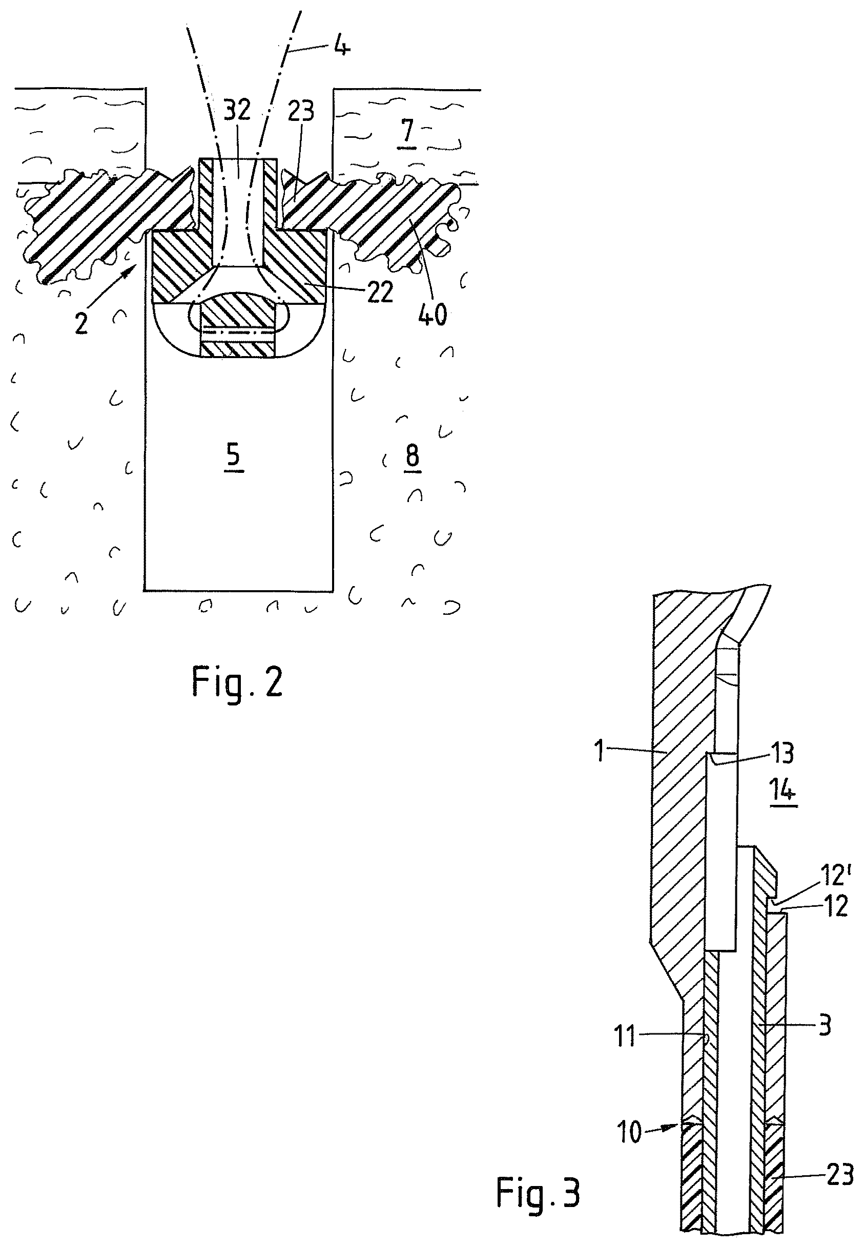 Patent US12569242 Figure 2 – Device and method for fixating a suture anchor in hard tissue