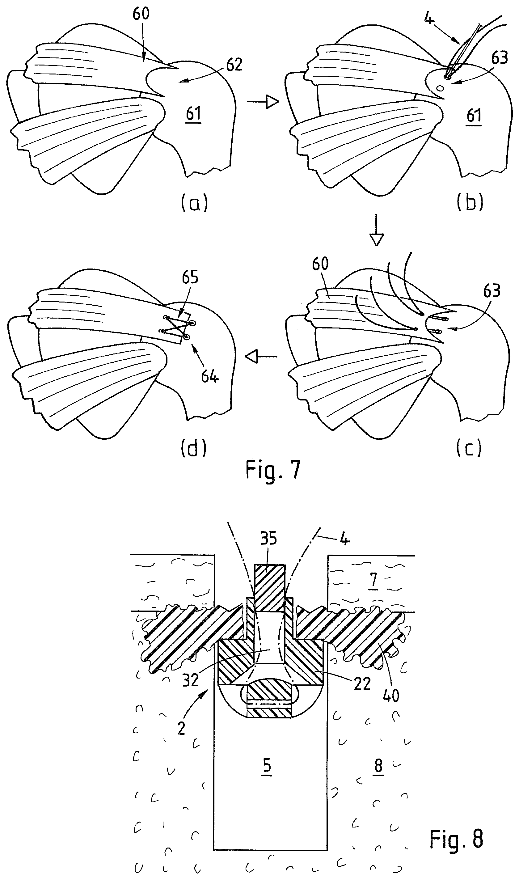 Patent US12569242 Figure 5 – Device and method for fixating a suture anchor in hard tissue